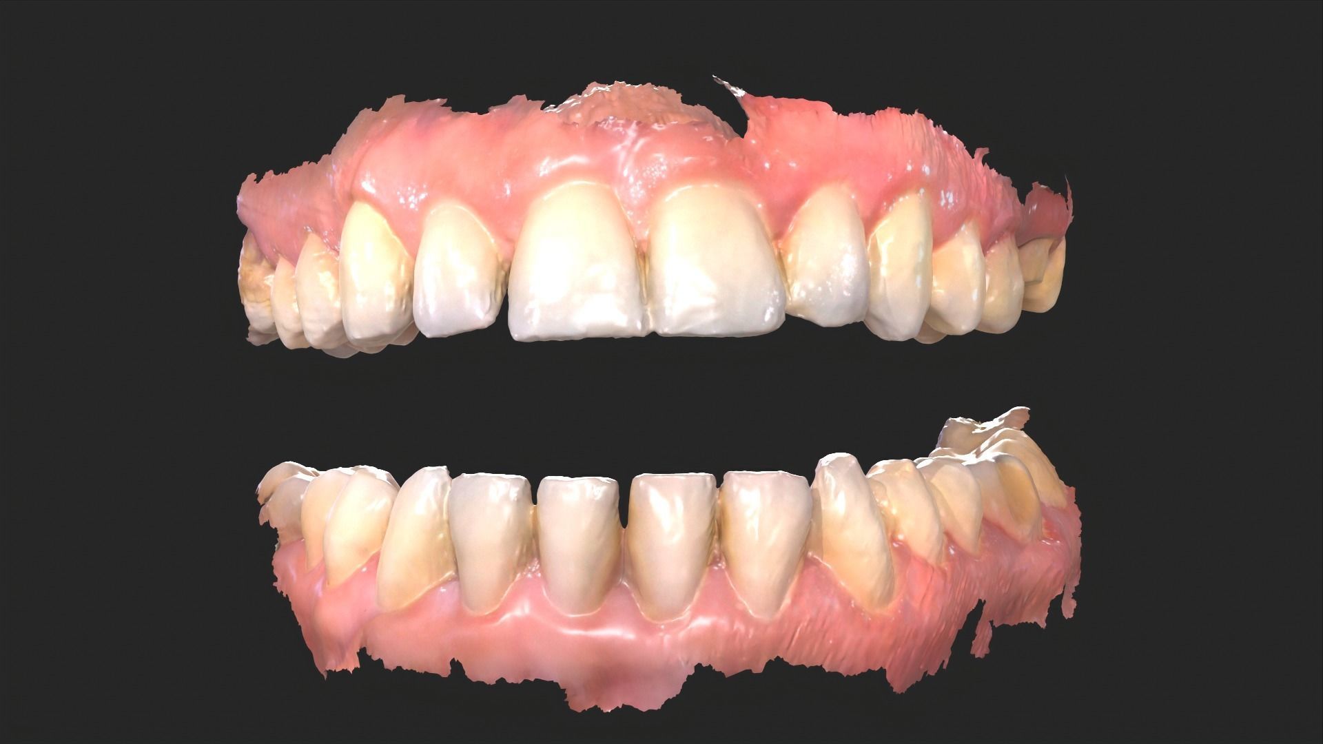 Dental Mouth Anatomy 3 Real Medical Cases Upper and Lower Jaw 3D print model_6