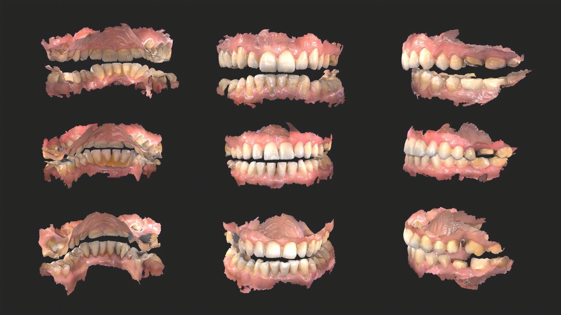 Dental Mouth Anatomy 3 Real Medical Cases Upper and Lower Jaw 3D print model_2