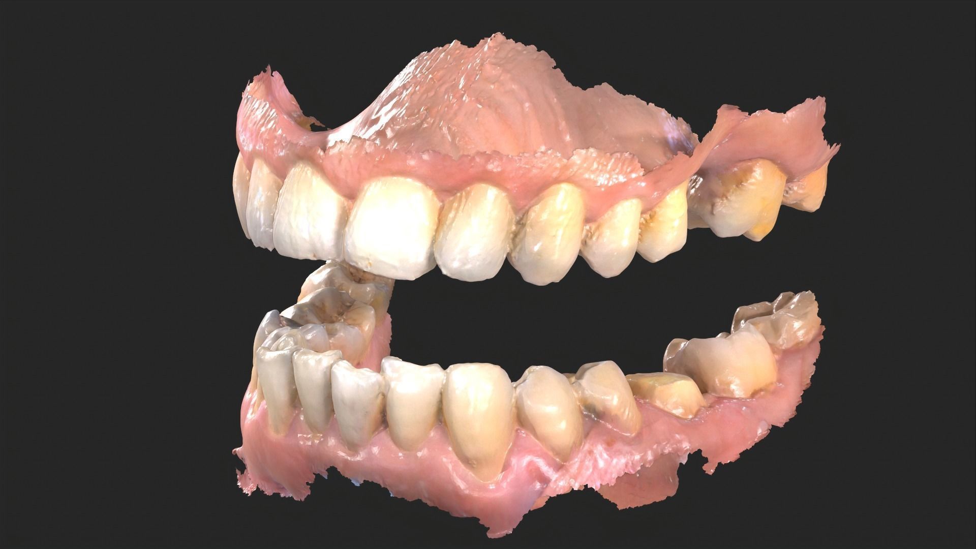 Dental Mouth Anatomy 3 Real Medical Cases Upper and Lower Jaw 3D print model_12