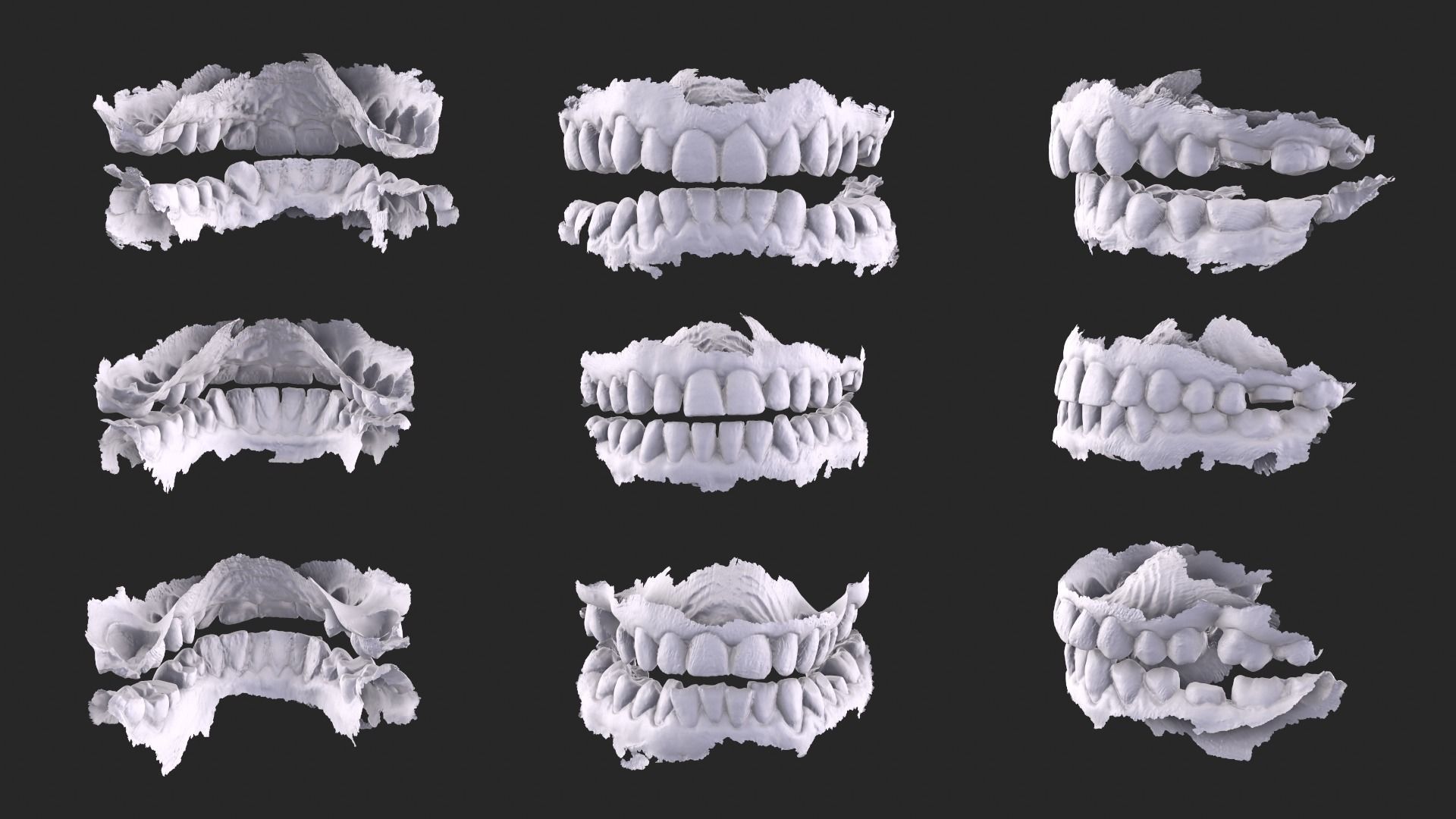Dental Mouth Anatomy 3 Real Medical Cases Upper and Lower Jaw 3D print model_4