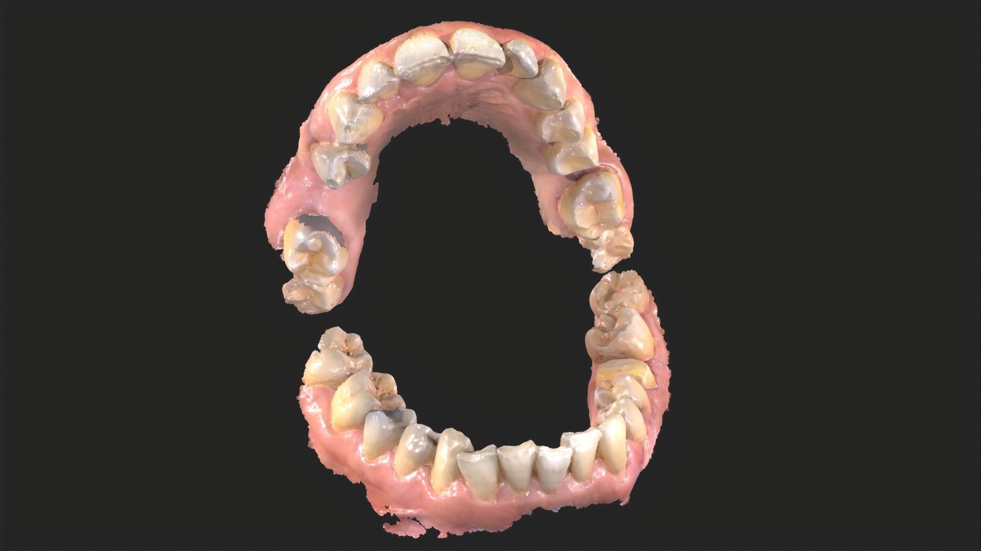 Dental Mouth Anatomy 3 Real Medical Cases Upper and Lower Jaw 3D print model_13