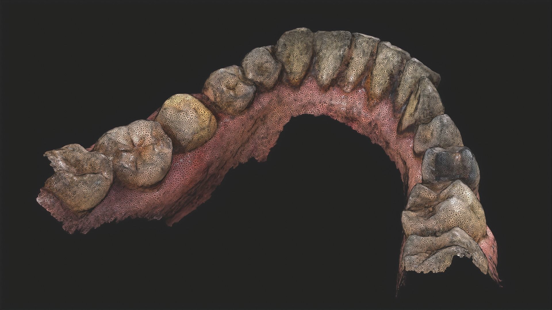 Dental Mouth Anatomy 3 Real Medical Cases Upper and Lower Jaw 3D print model_15