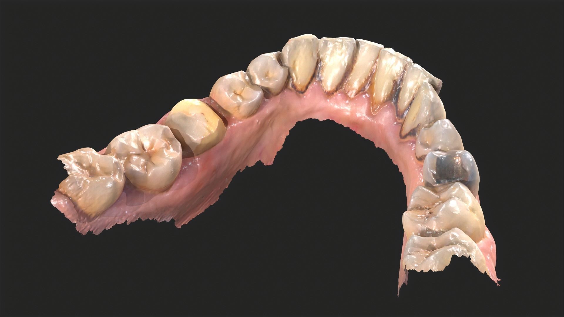 Dental Mouth Anatomy 3 Real Medical Cases Upper and Lower Jaw 3D print model_14