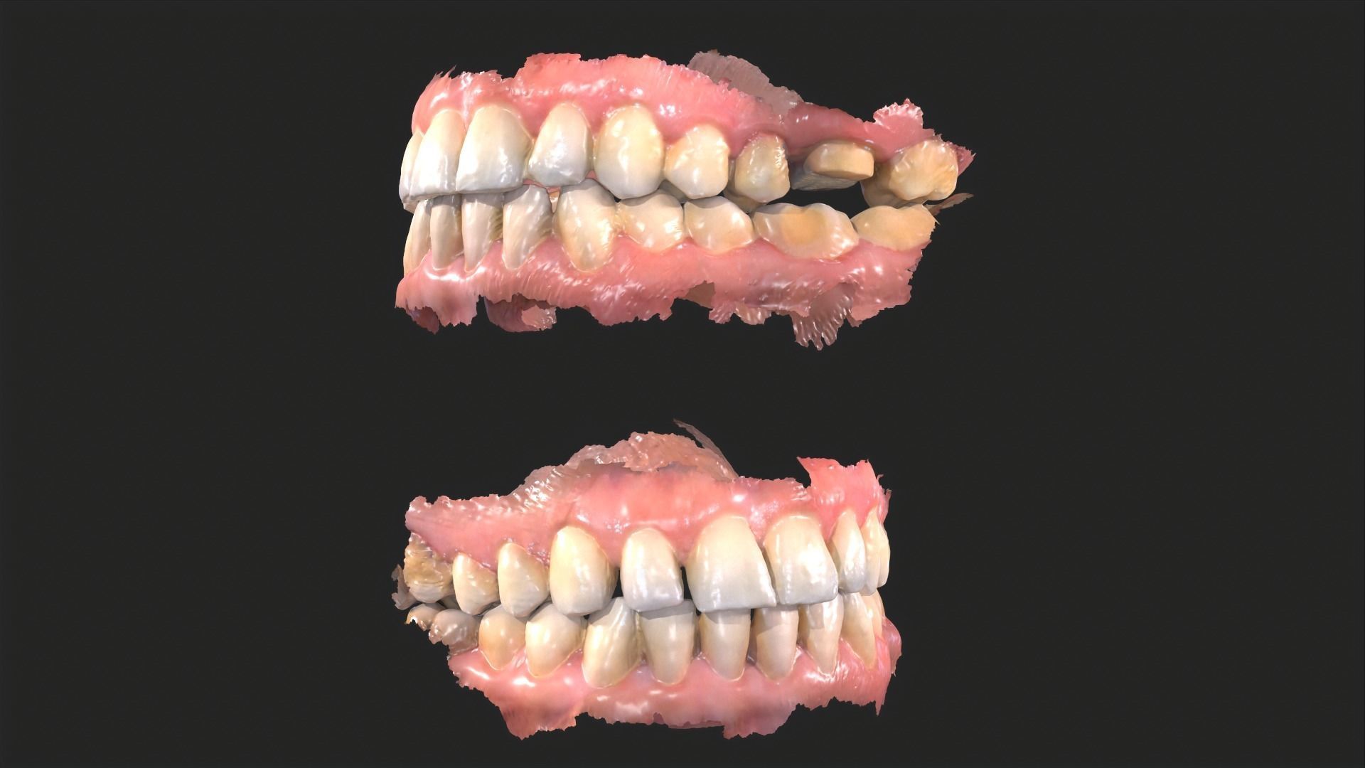 Dental Mouth Anatomy 3 Real Medical Cases Upper and Lower Jaw 3D print model_3