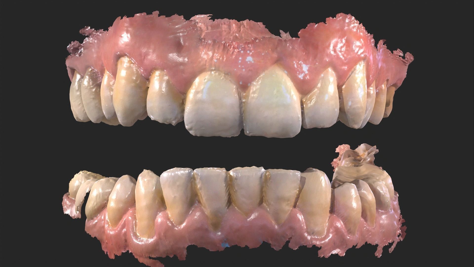 Dental Mouth Anatomy 3 Real Medical Cases Upper and Lower Jaw 3D print model_10