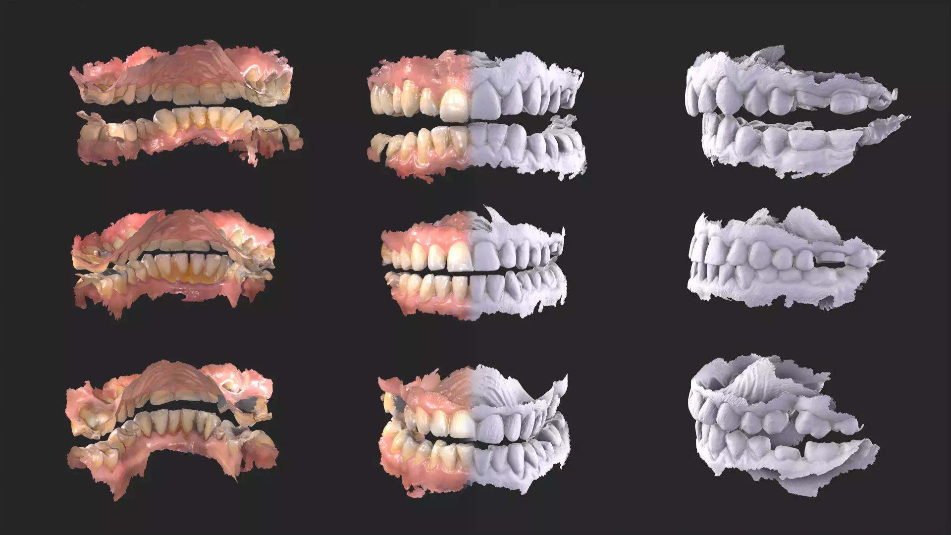 Dental Mouth Anatomy 3 Real Medical Cases Upper and Lower Jaw 3D print model_0