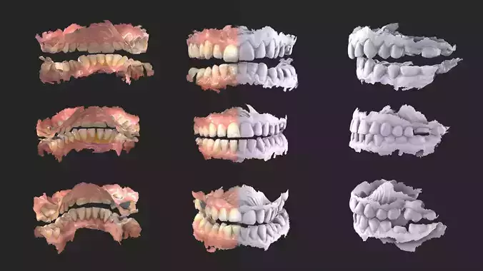 Dental Mouth Anatomy 3 Real Medical Cases Upper and Lower Jaw 3D print model