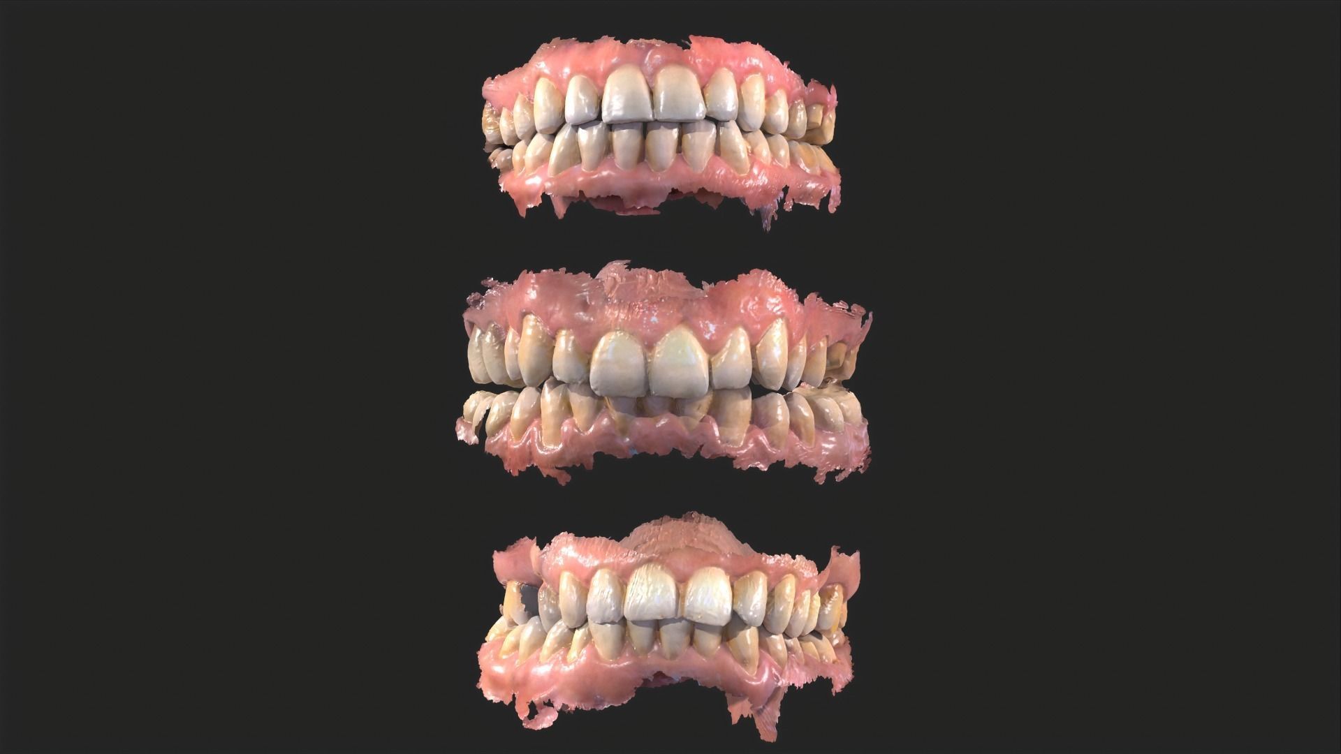 Dental Mouth Anatomy 3 Real Medical Cases Upper and Lower Jaw 3D print model_9