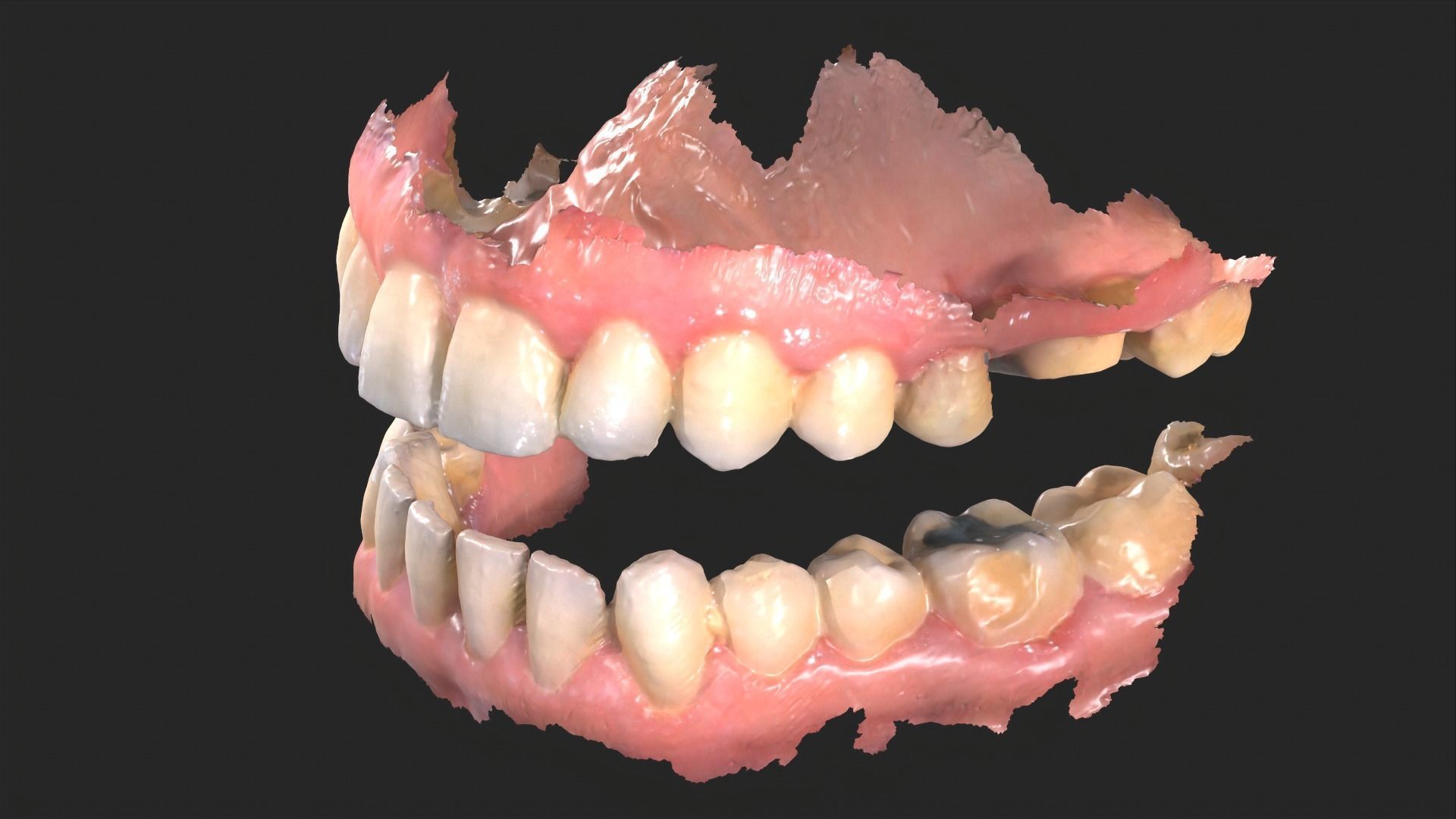 Dental Mouth Anatomy 3 Real Medical Cases Upper and Lower Jaw 3D print model_8