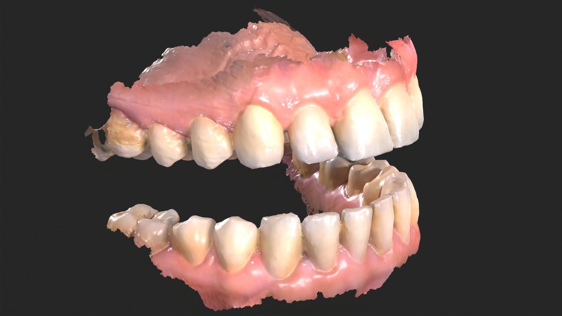 Dental Mouth Anatomy 3 Real Medical Cases Upper and Lower Jaw 3D print model_7