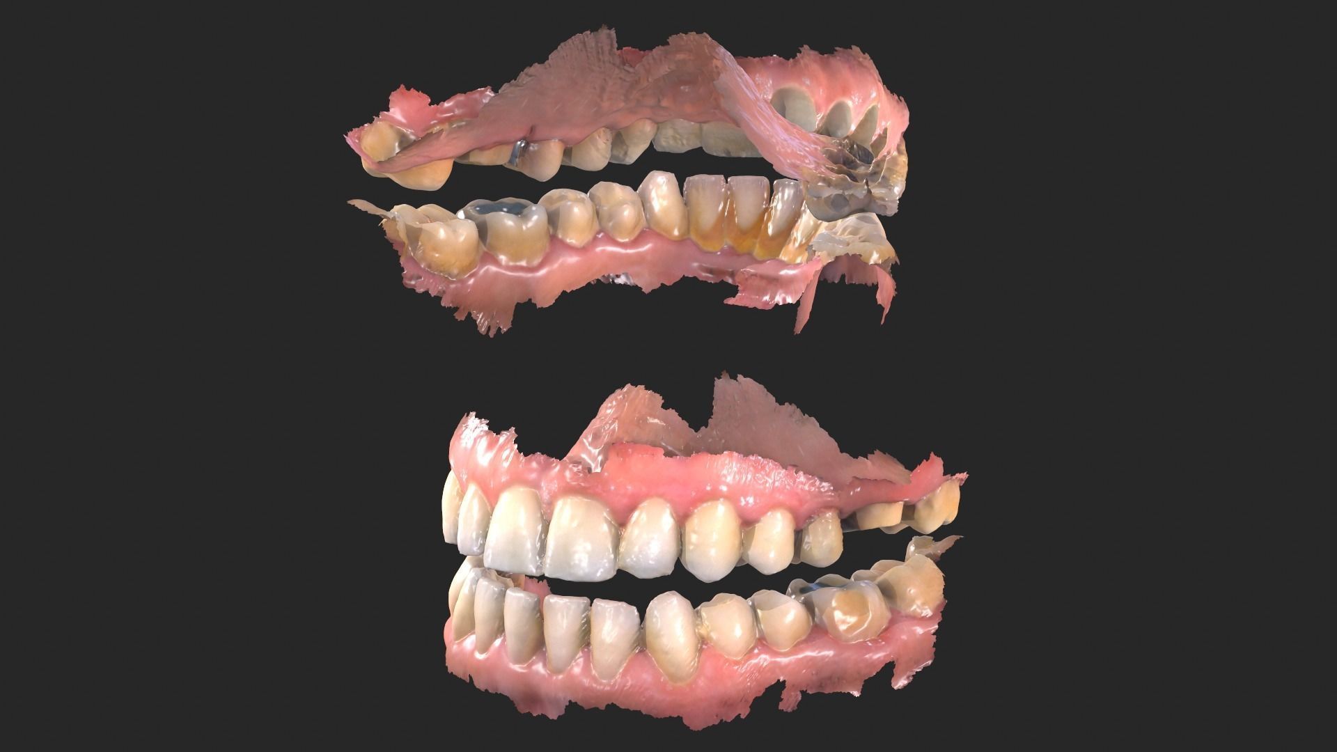 Dental Mouth Anatomy 3 Real Medical Cases Upper and Lower Jaw 3D print model_5