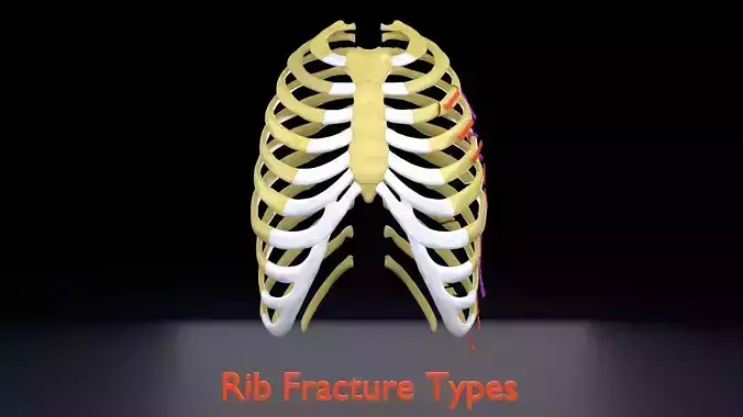 Rib fracture and its types