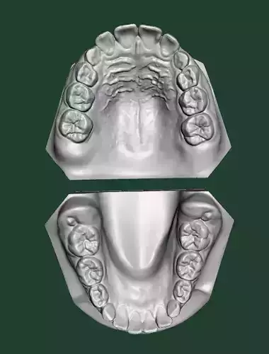 D013 Pediatric dental model from IOS 3D print model