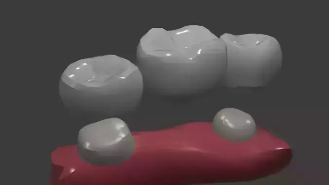 Tooth supported fixed bridge  and Animation 3D model