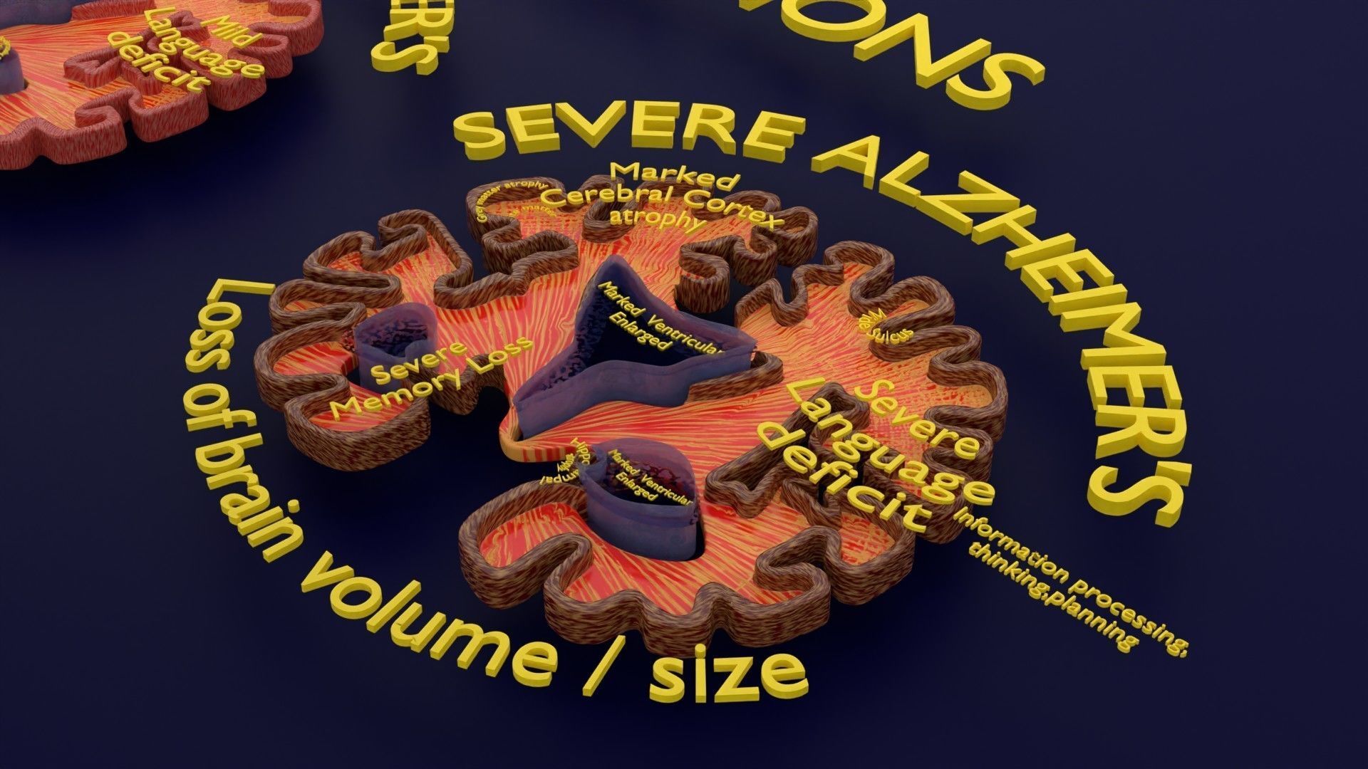 Alzheimer Disease Brain coronal slice 3D model_43