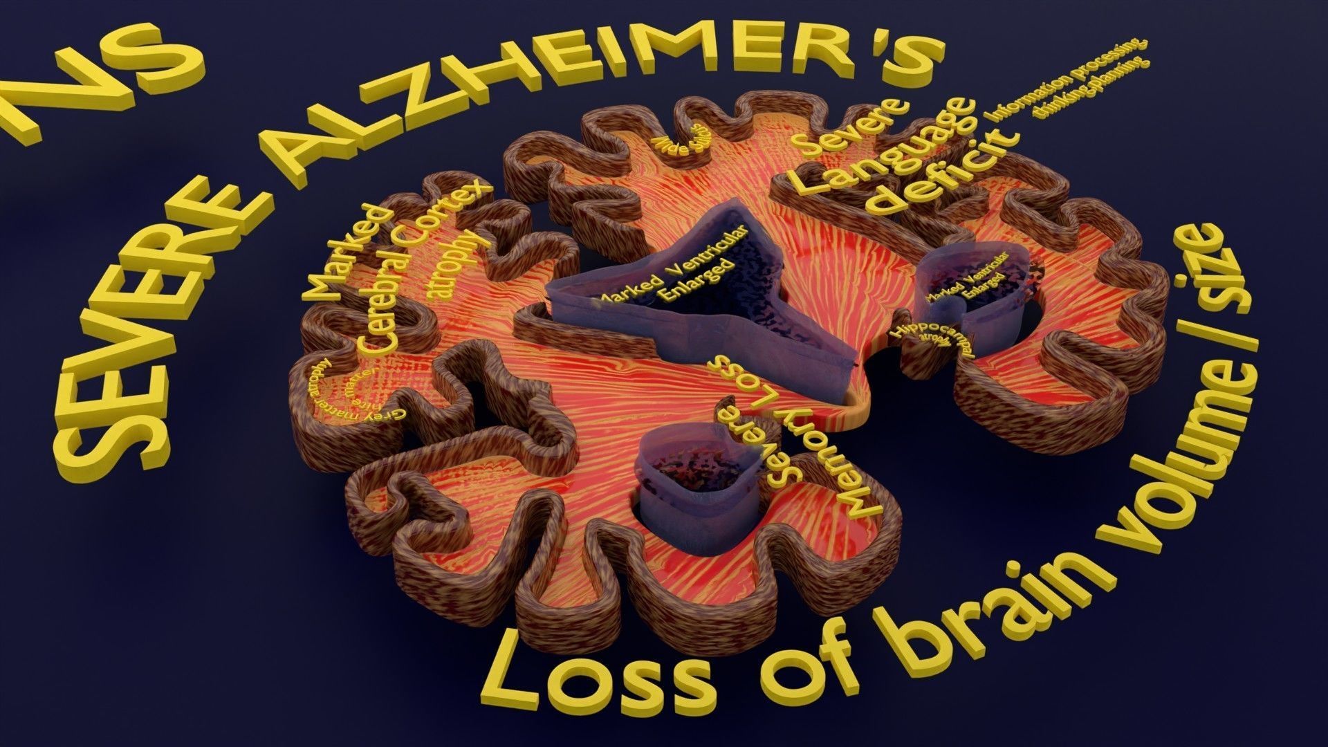 Alzheimer Disease Brain coronal slice 3D model_1