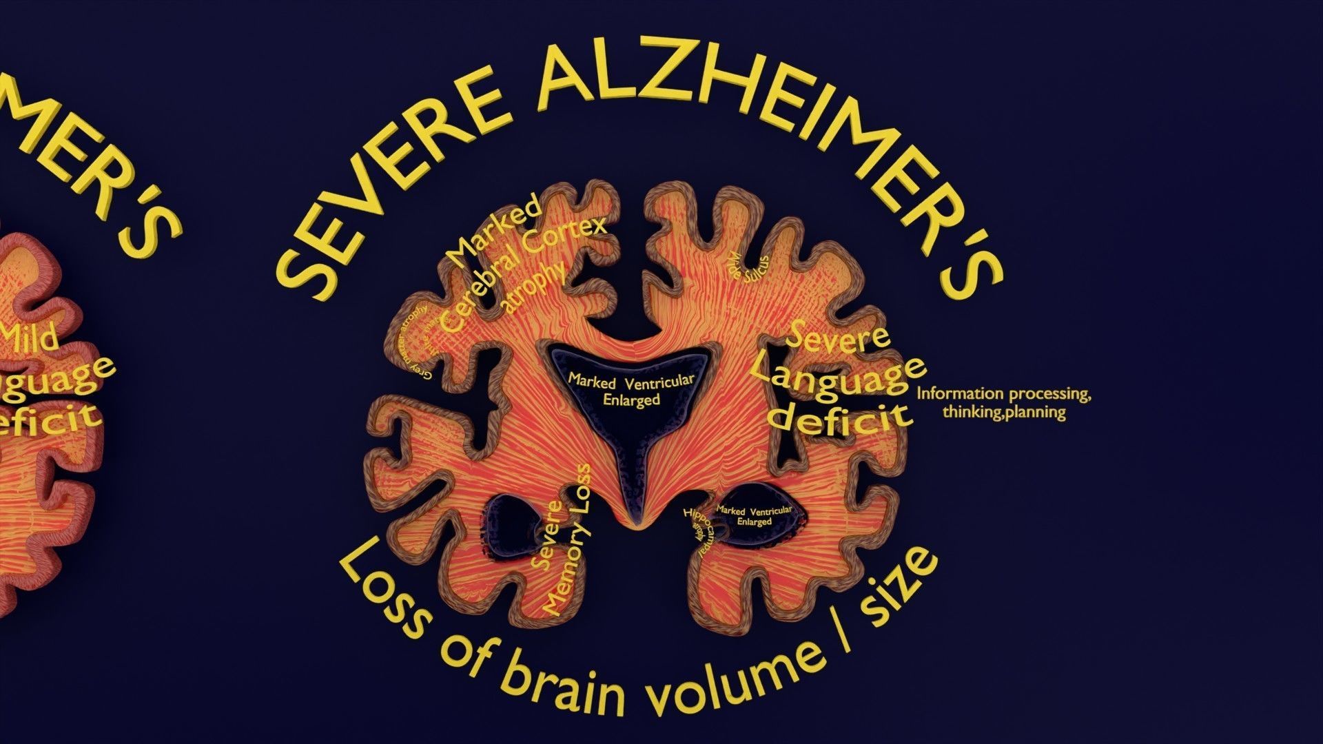 Alzheimer Disease Brain coronal slice 3D model_4