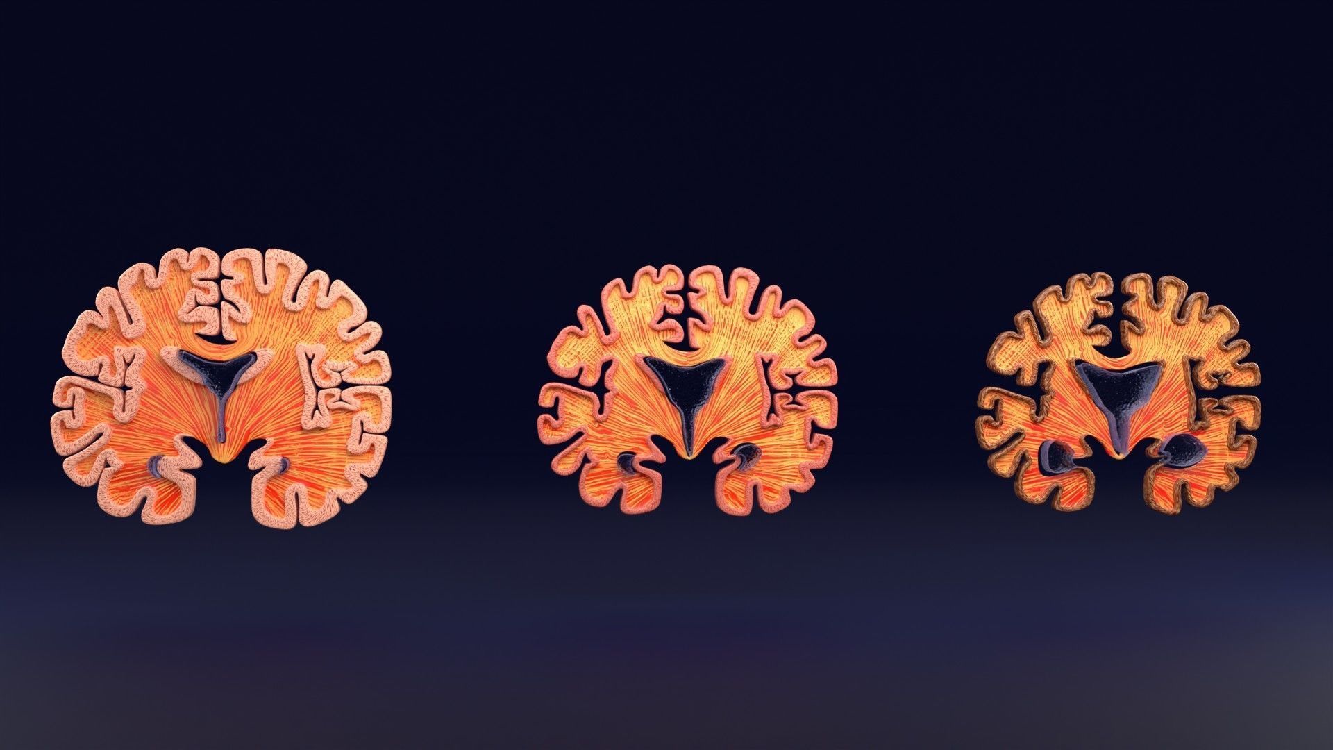 Alzheimer Disease Brain coronal slice 3D model_39