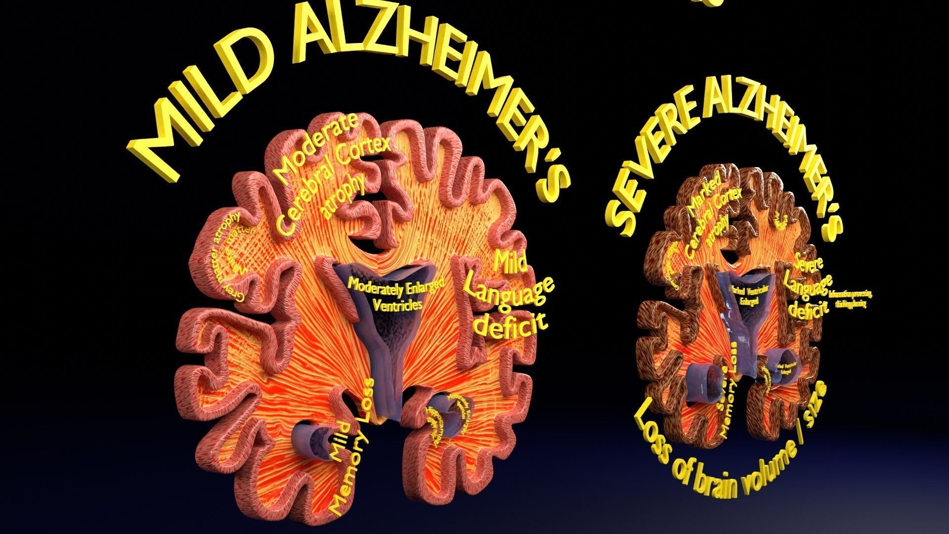 Alzheimer Disease Brain coronal slice 3D model_32