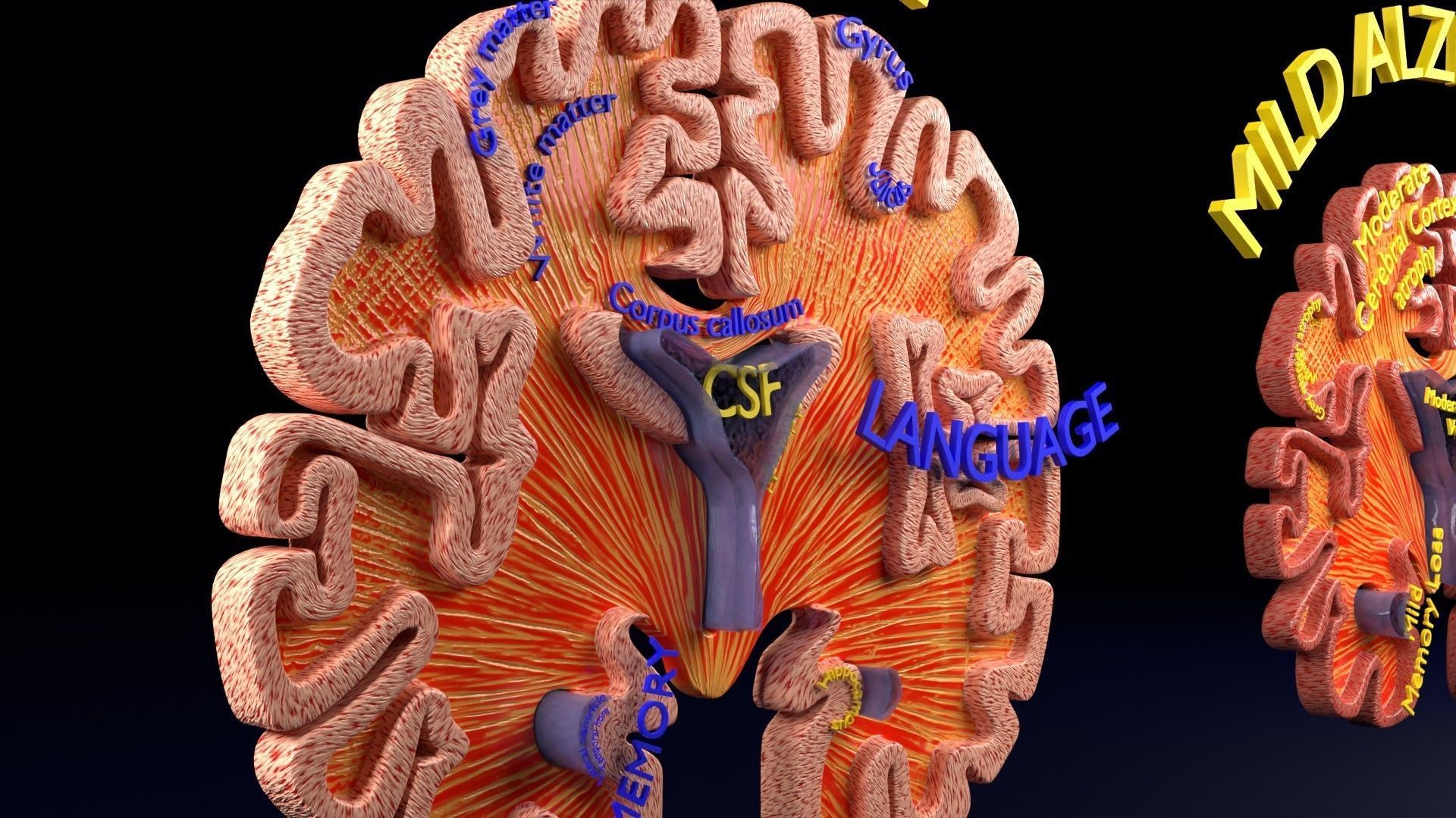 Alzheimer Disease Brain coronal slice 3D model_35