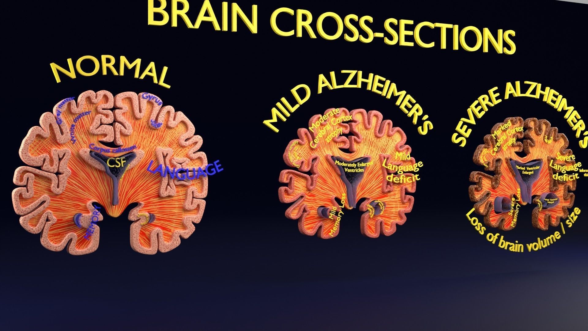 Alzheimer Disease Brain coronal slice 3D model_37