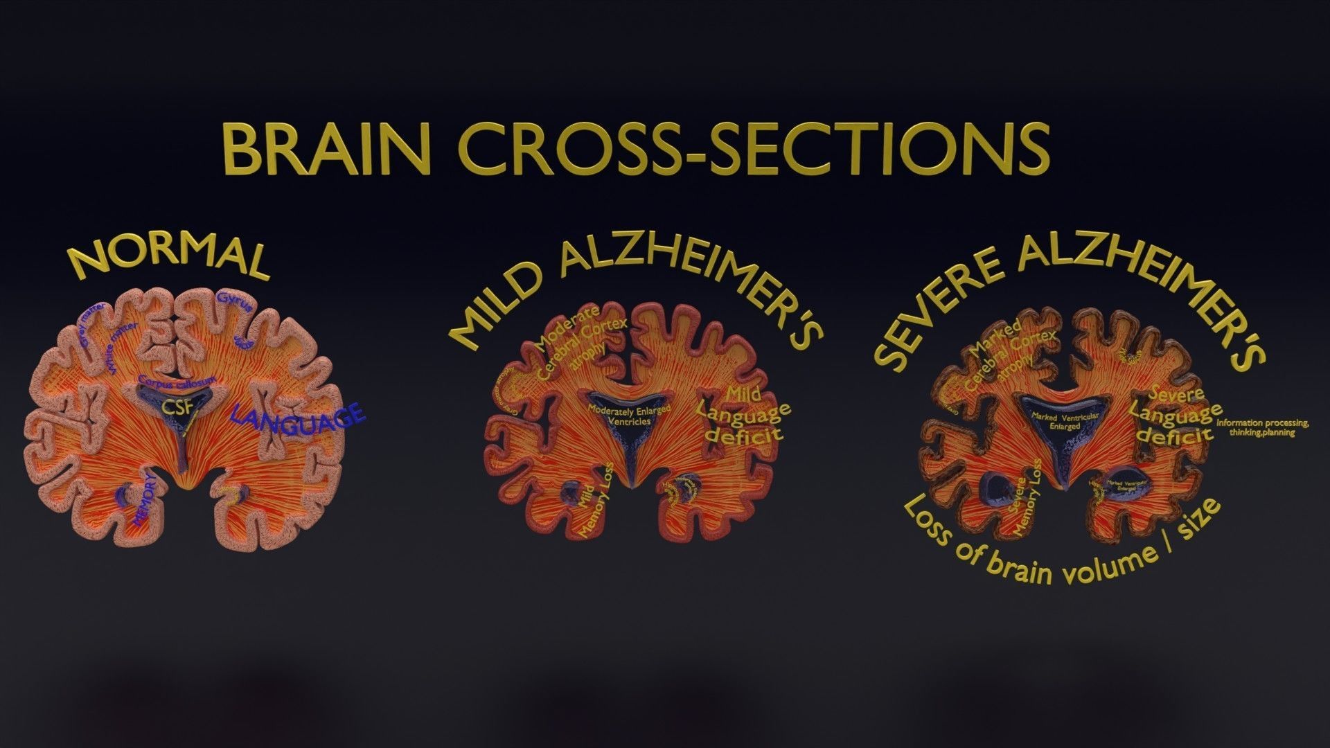 Alzheimer Disease Brain coronal slice 3D model_10