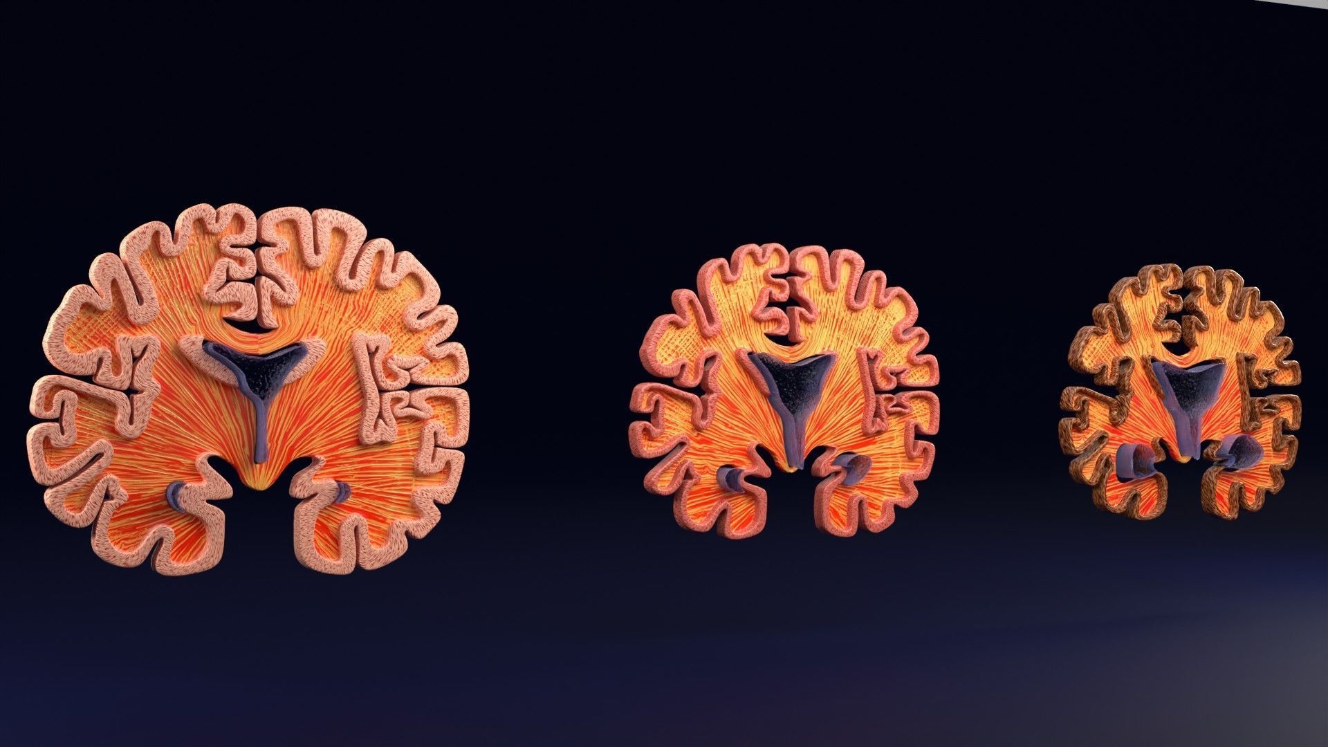 Alzheimer Disease Brain coronal slice 3D model_38