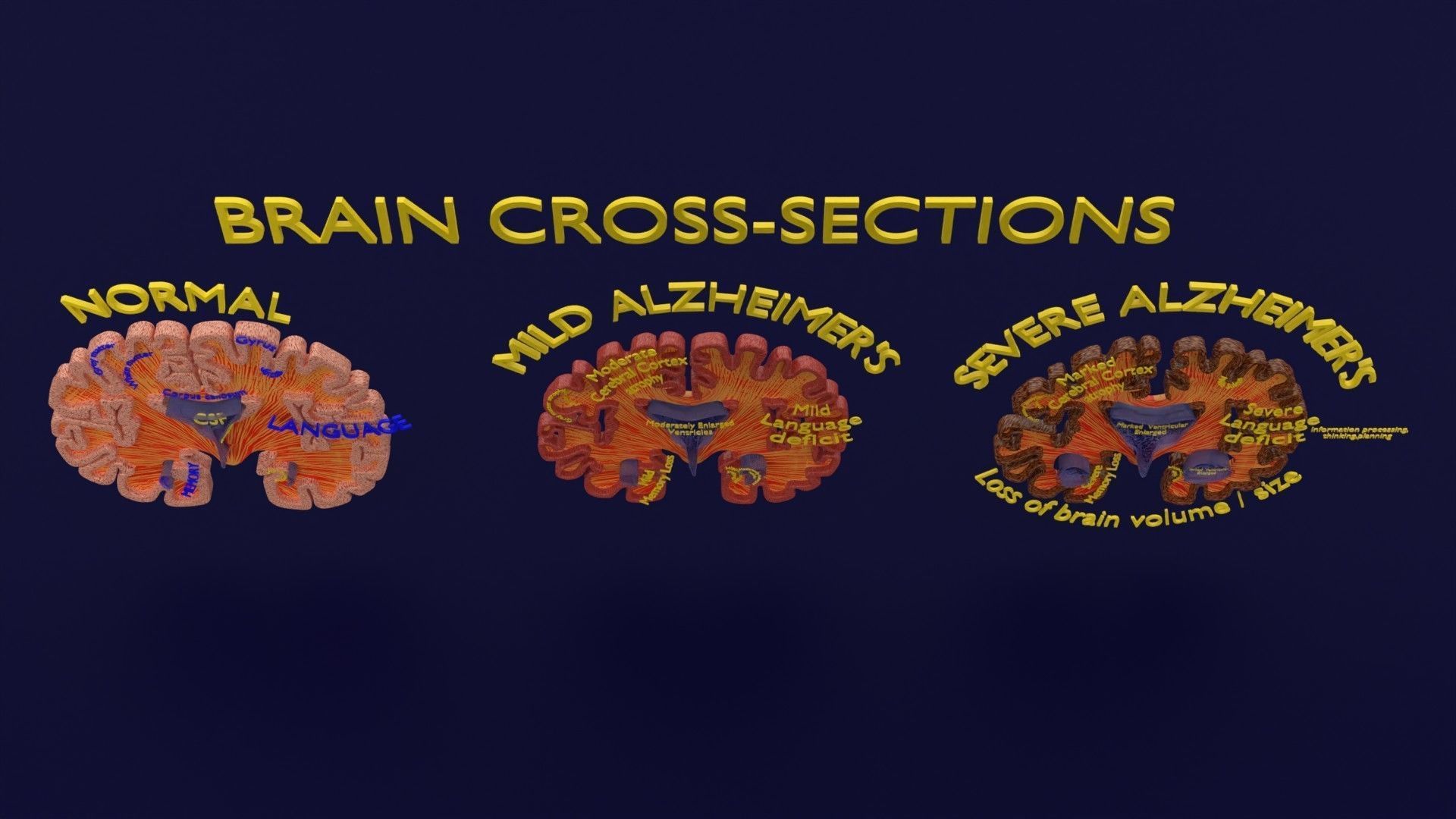 Alzheimer Disease Brain coronal slice 3D model_8