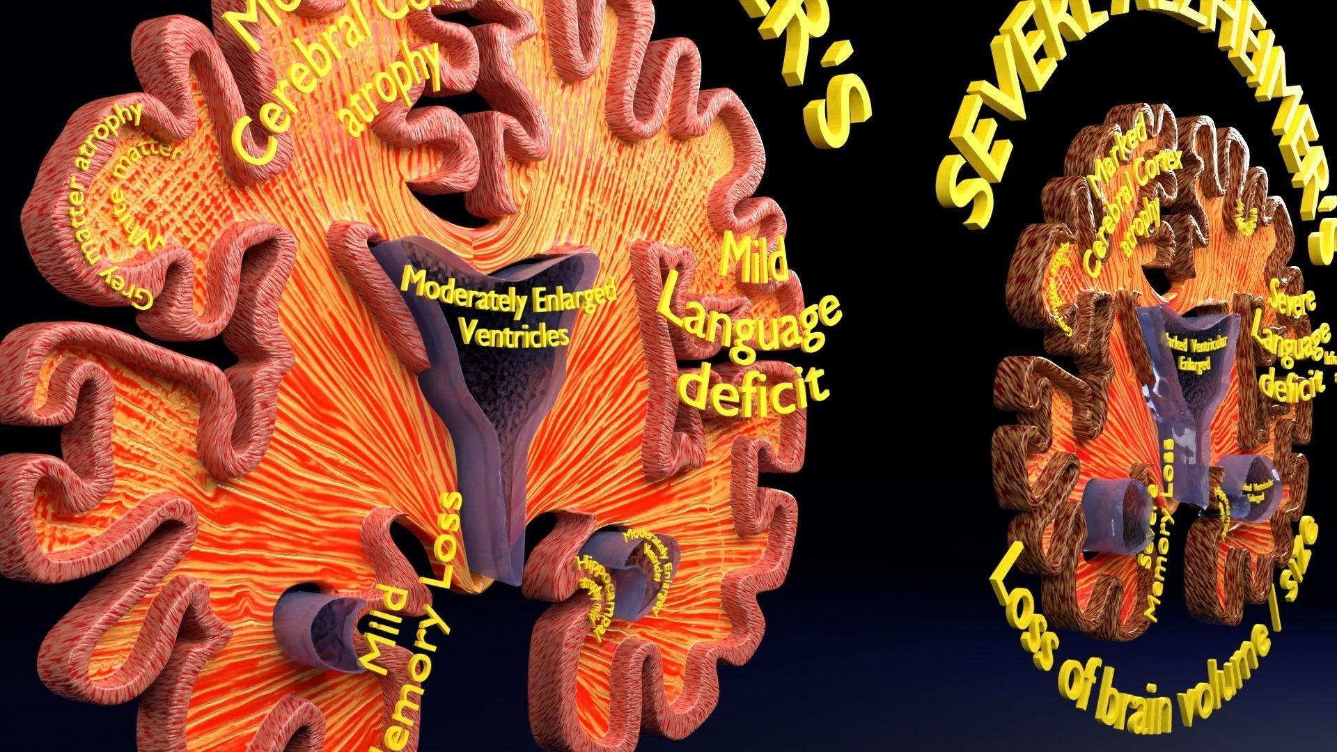 Alzheimer Disease Brain coronal slice 3D model_31