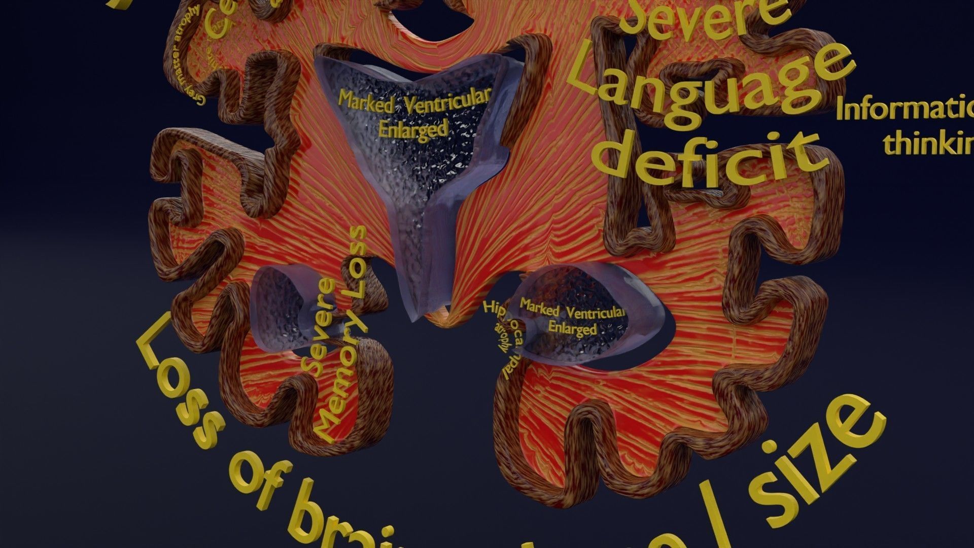 Alzheimer Disease Brain coronal slice 3D model_19