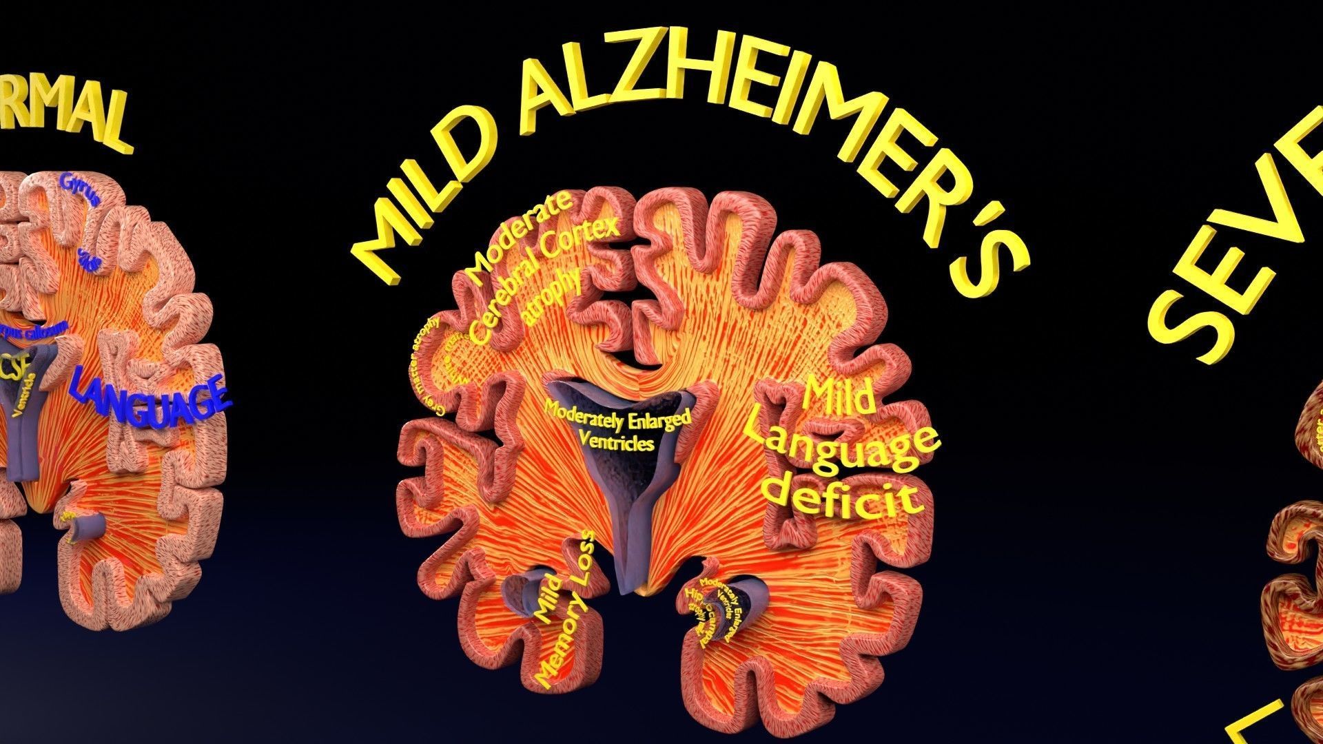 Alzheimer Disease Brain coronal slice 3D model_25