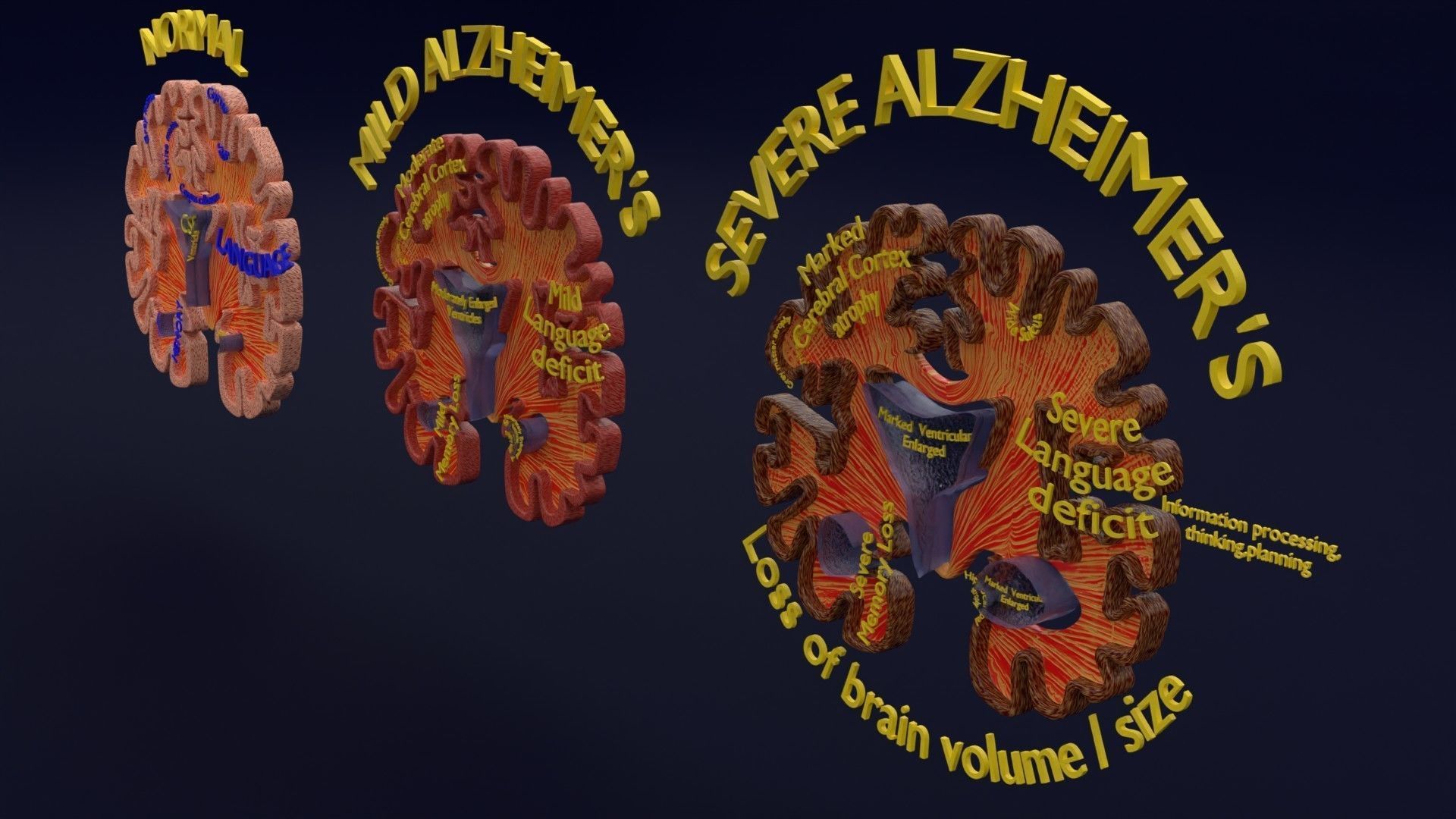 Alzheimer Disease Brain coronal slice 3D model_16