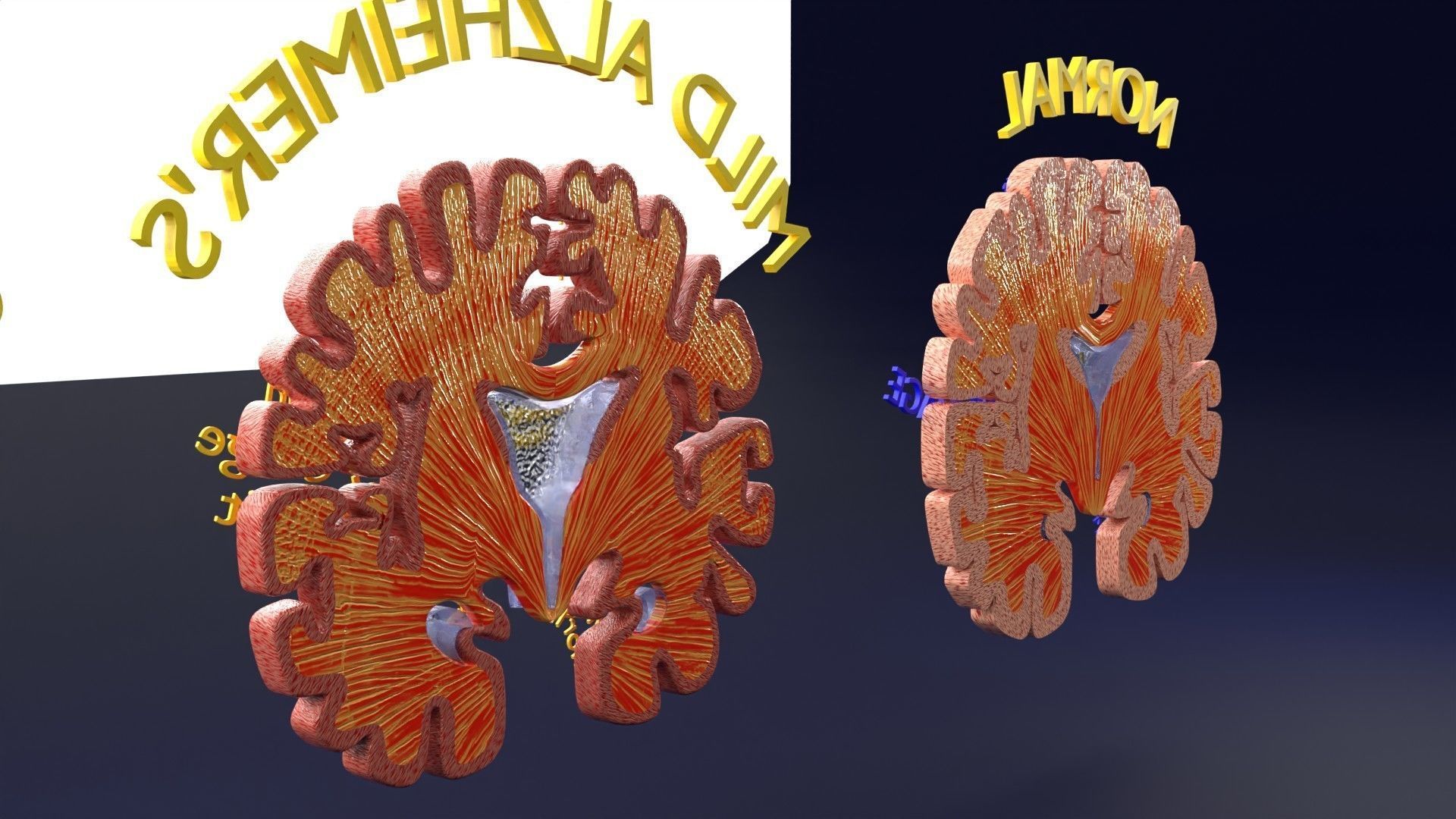 Alzheimer Disease Brain coronal slice 3D model_23