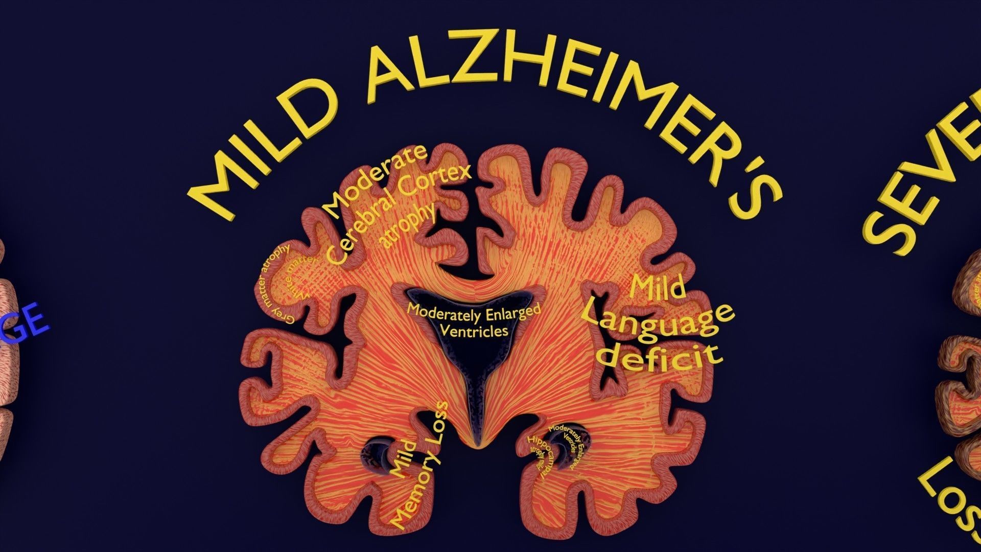 Alzheimer Disease Brain coronal slice 3D model_3