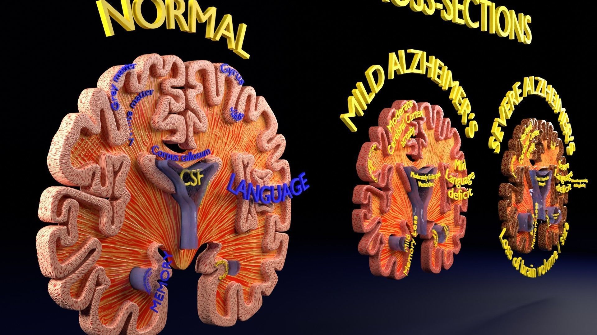 Alzheimer Disease Brain coronal slice 3D model_34