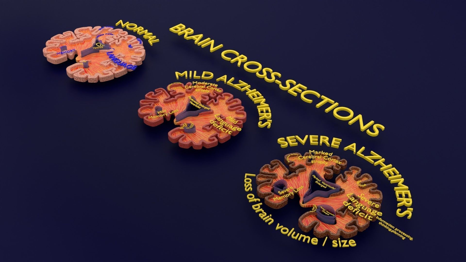 Alzheimer Disease Brain coronal slice 3D model_33