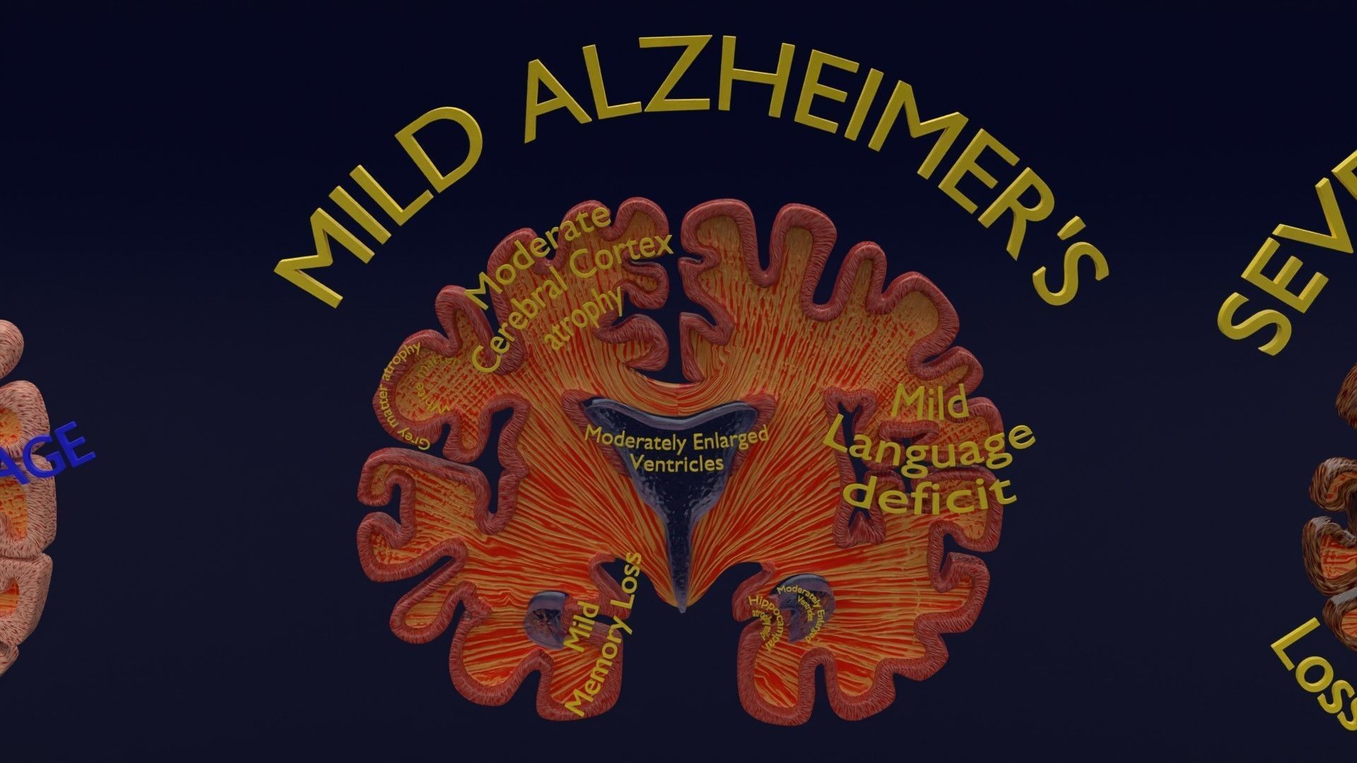 Alzheimer Disease Brain coronal slice 3D model_14