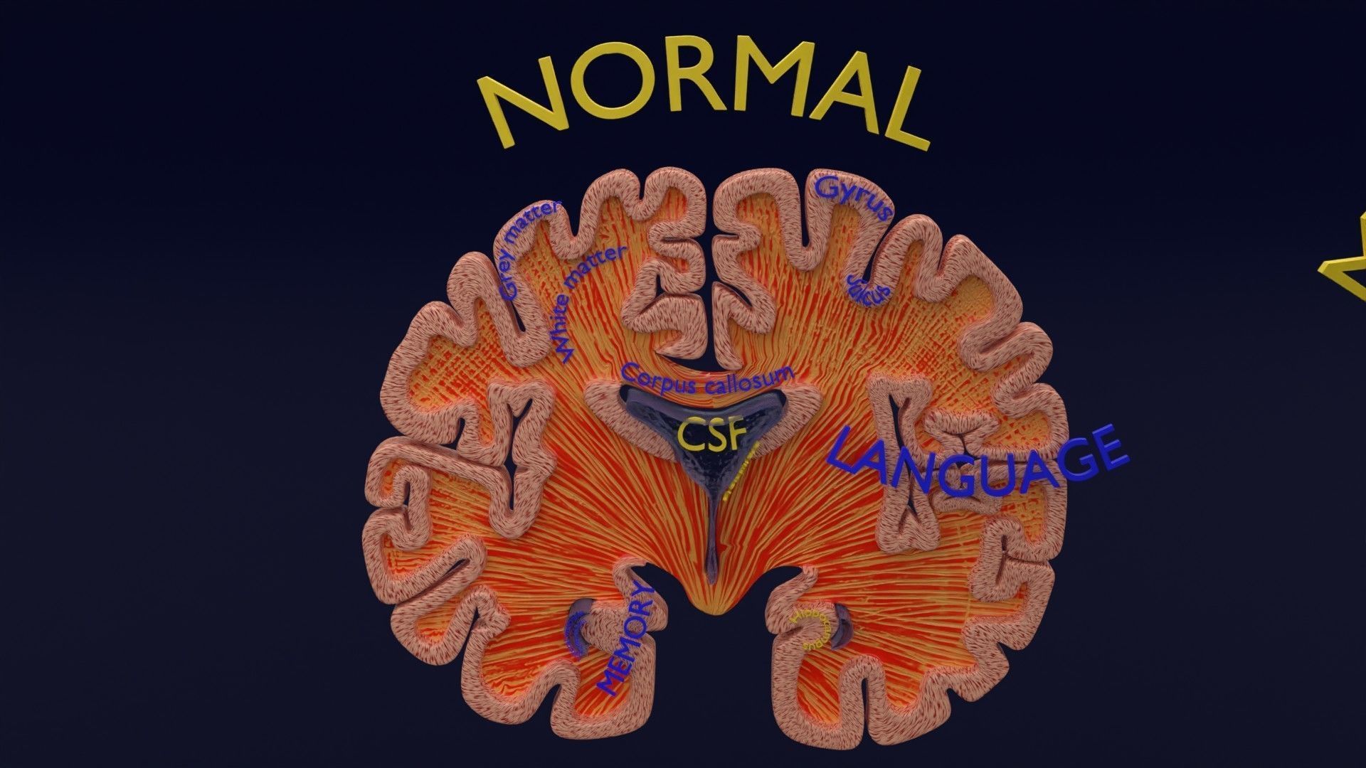 Alzheimer Disease Brain coronal slice 3D model_13