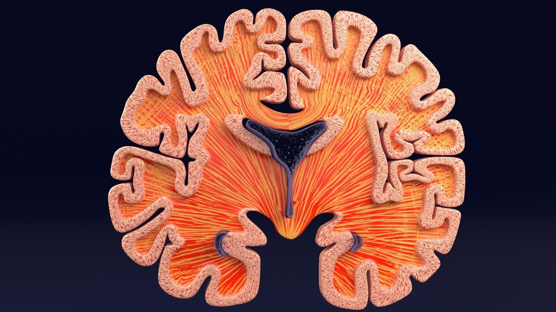 Alzheimer Disease Brain coronal slice 3D model_40