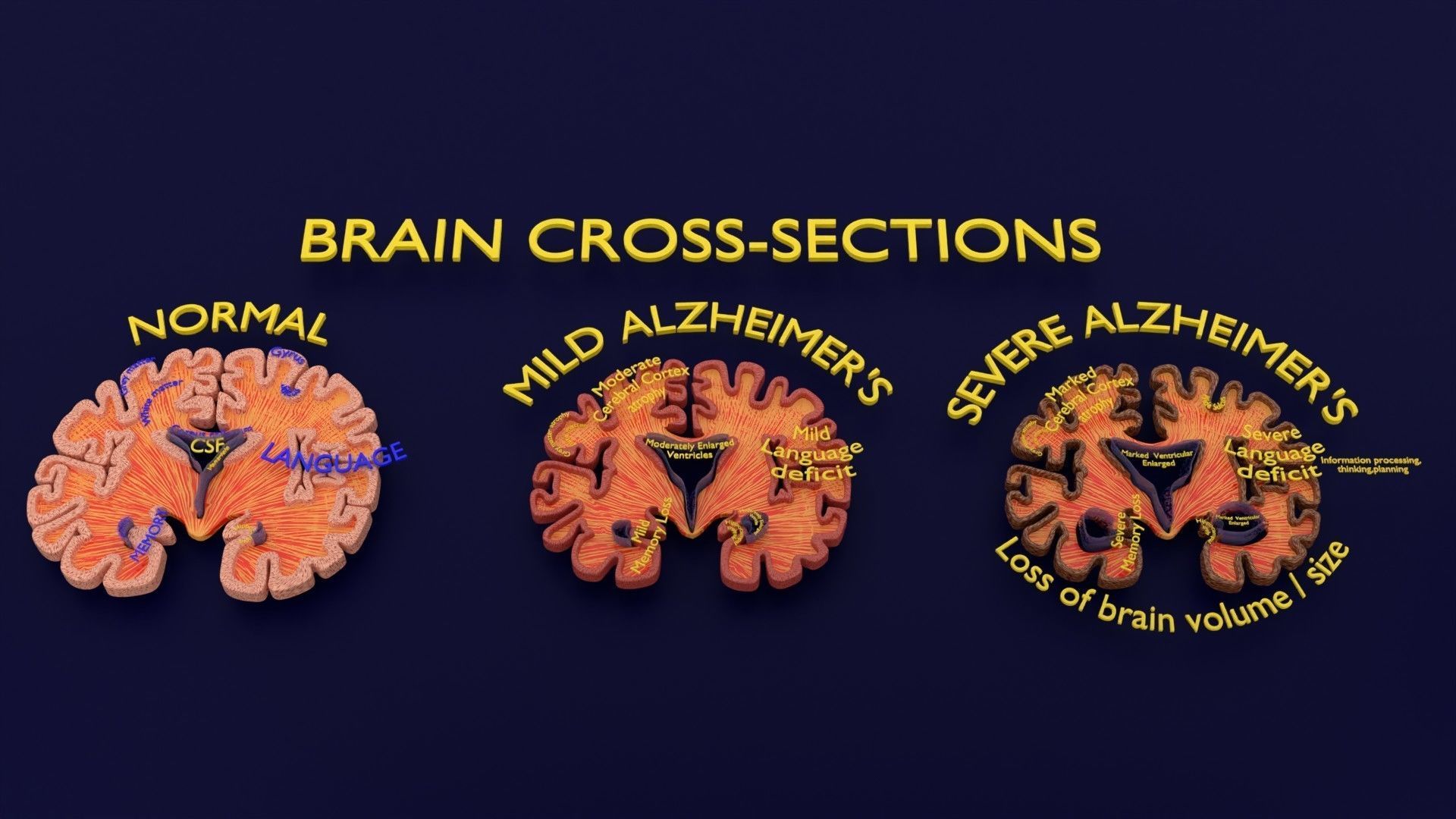 Alzheimer Disease Brain coronal slice 3D model_6