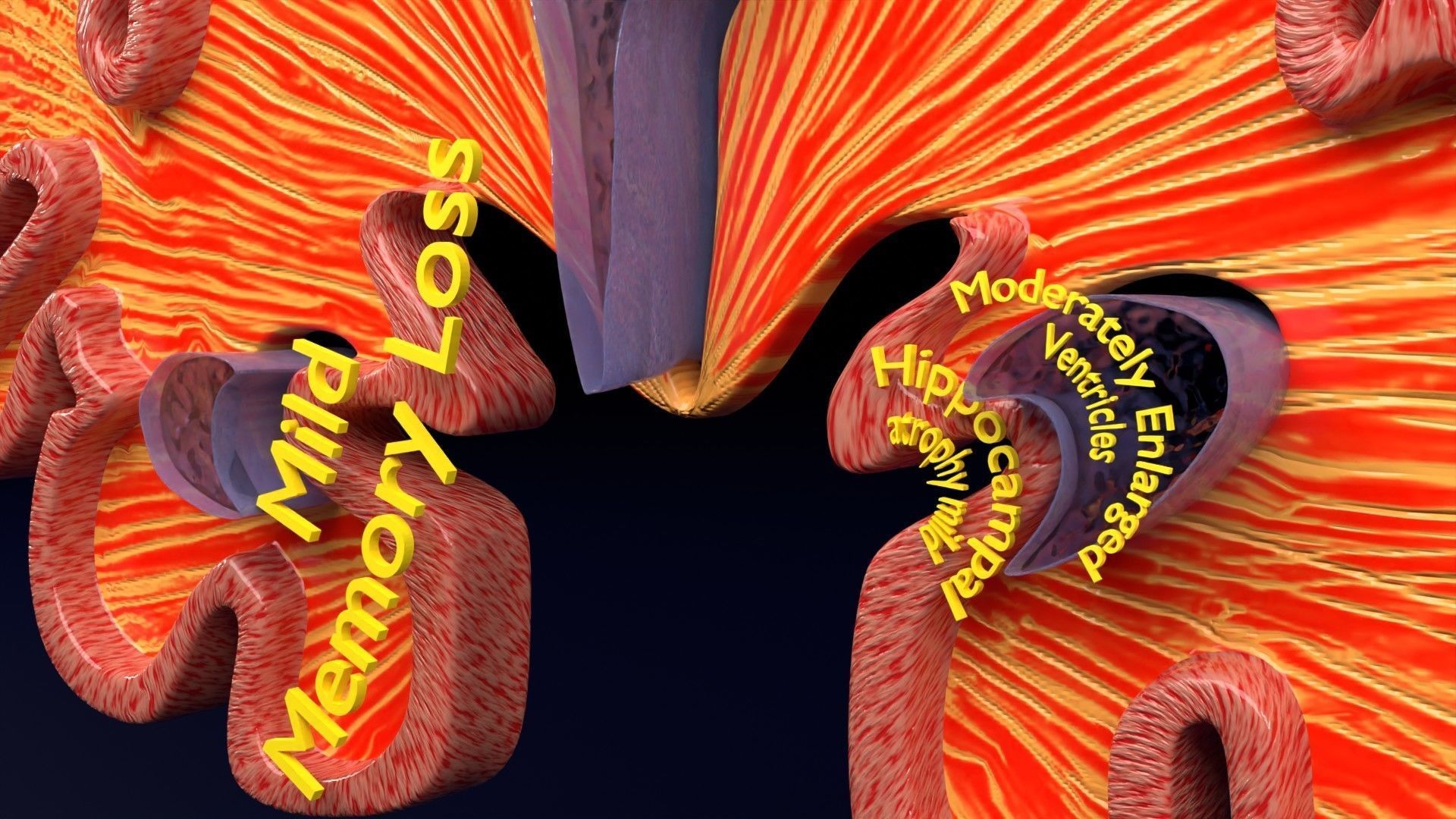 Alzheimer Disease Brain coronal slice 3D model_27