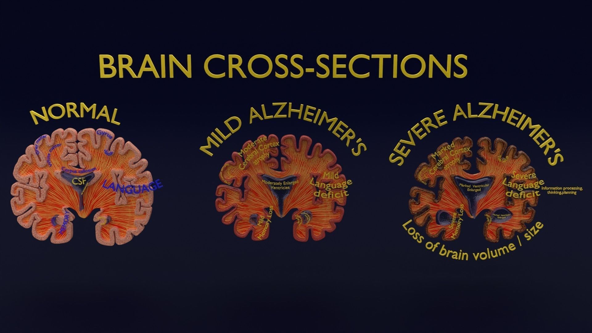 Alzheimer Disease Brain coronal slice 3D model_12