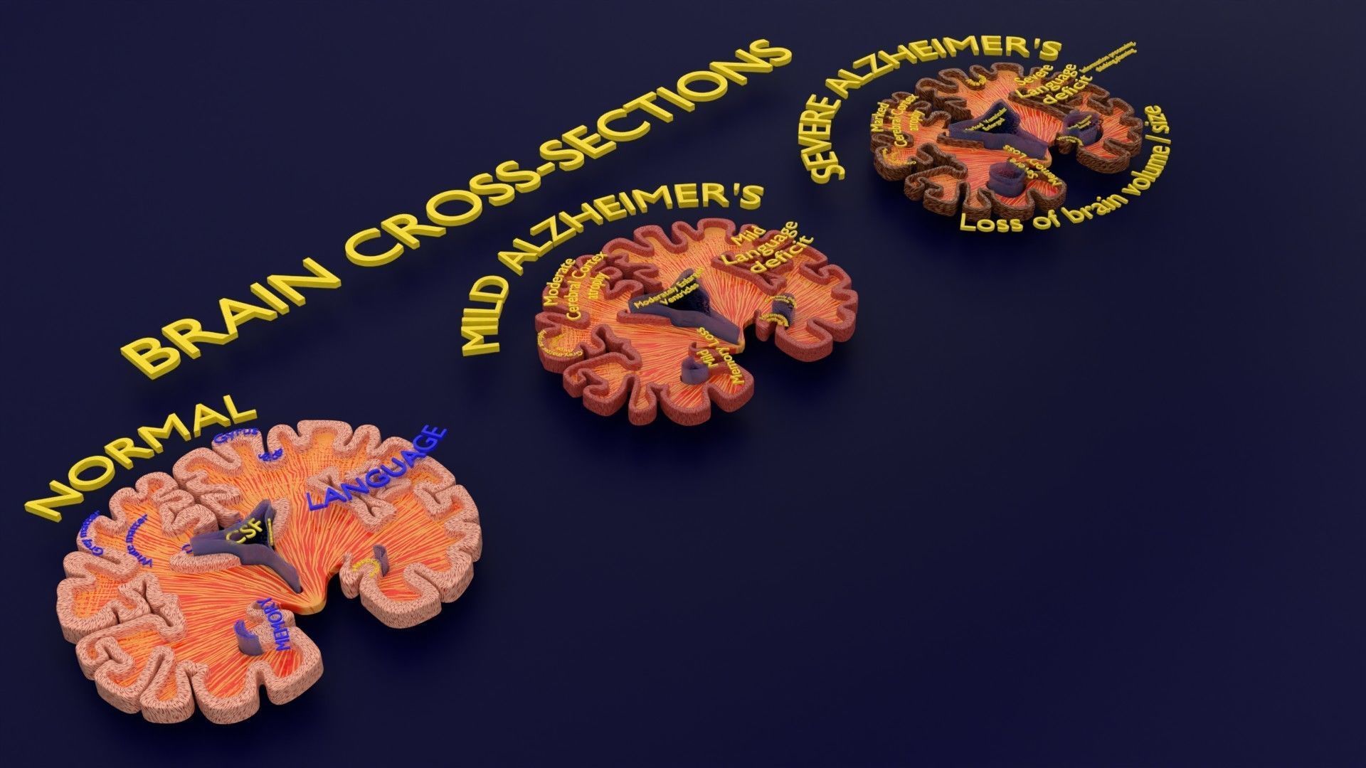 Alzheimer Disease Brain coronal slice 3D model_22