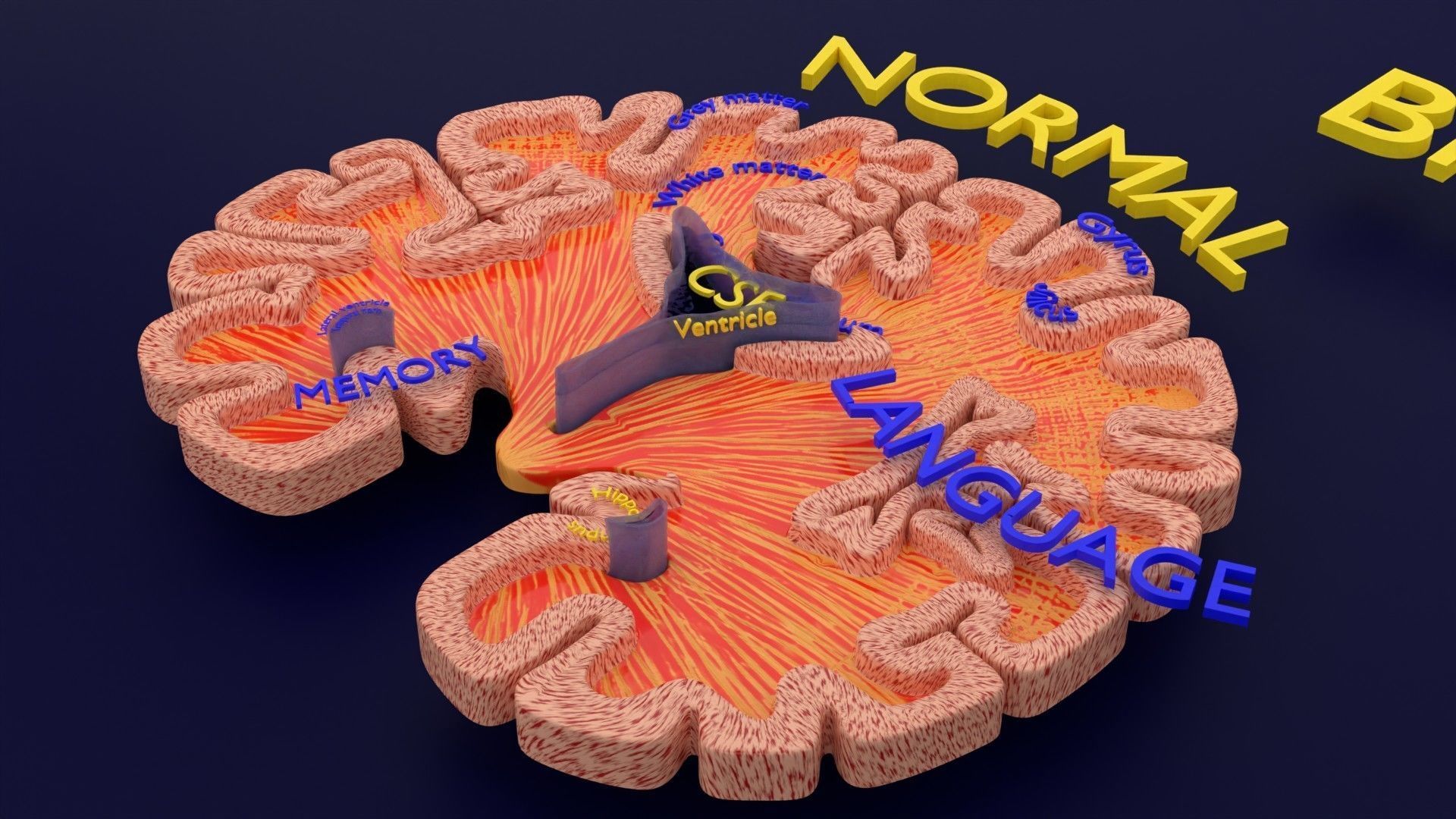 Alzheimer Disease Brain coronal slice 3D model_45