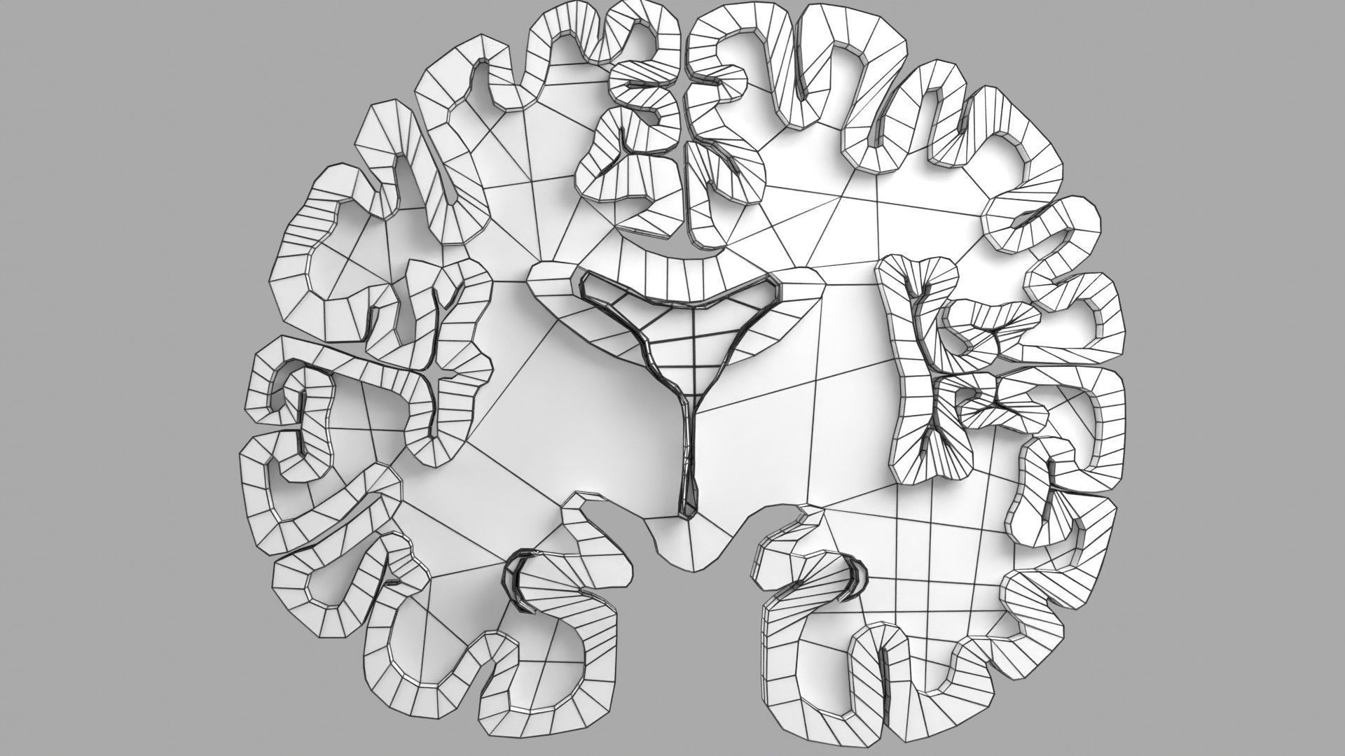 Alzheimer Disease Brain coronal slice 3D model_56