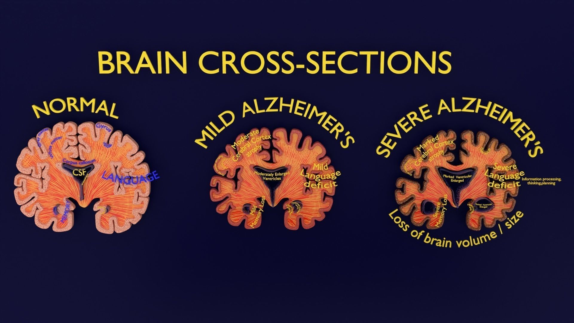 Alzheimer Disease Brain coronal slice 3D model_7