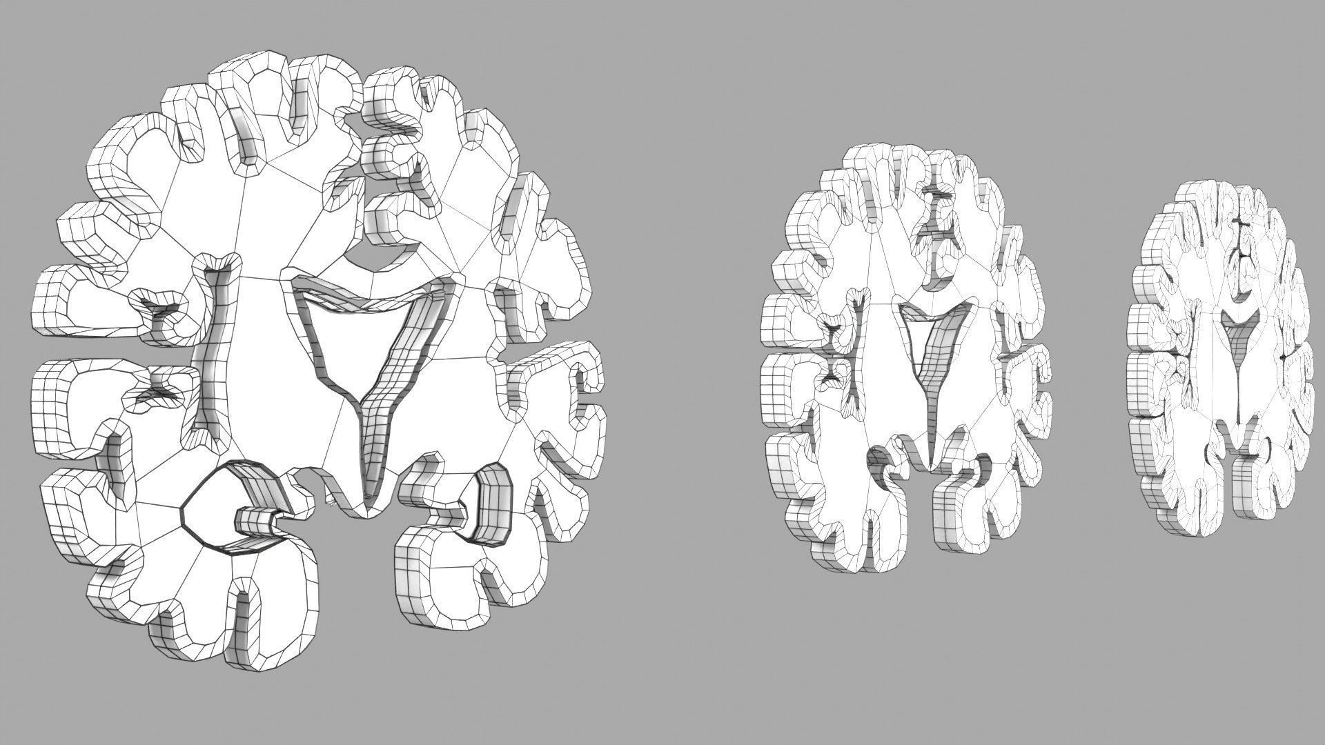 Alzheimer Disease Brain coronal slice 3D model_52