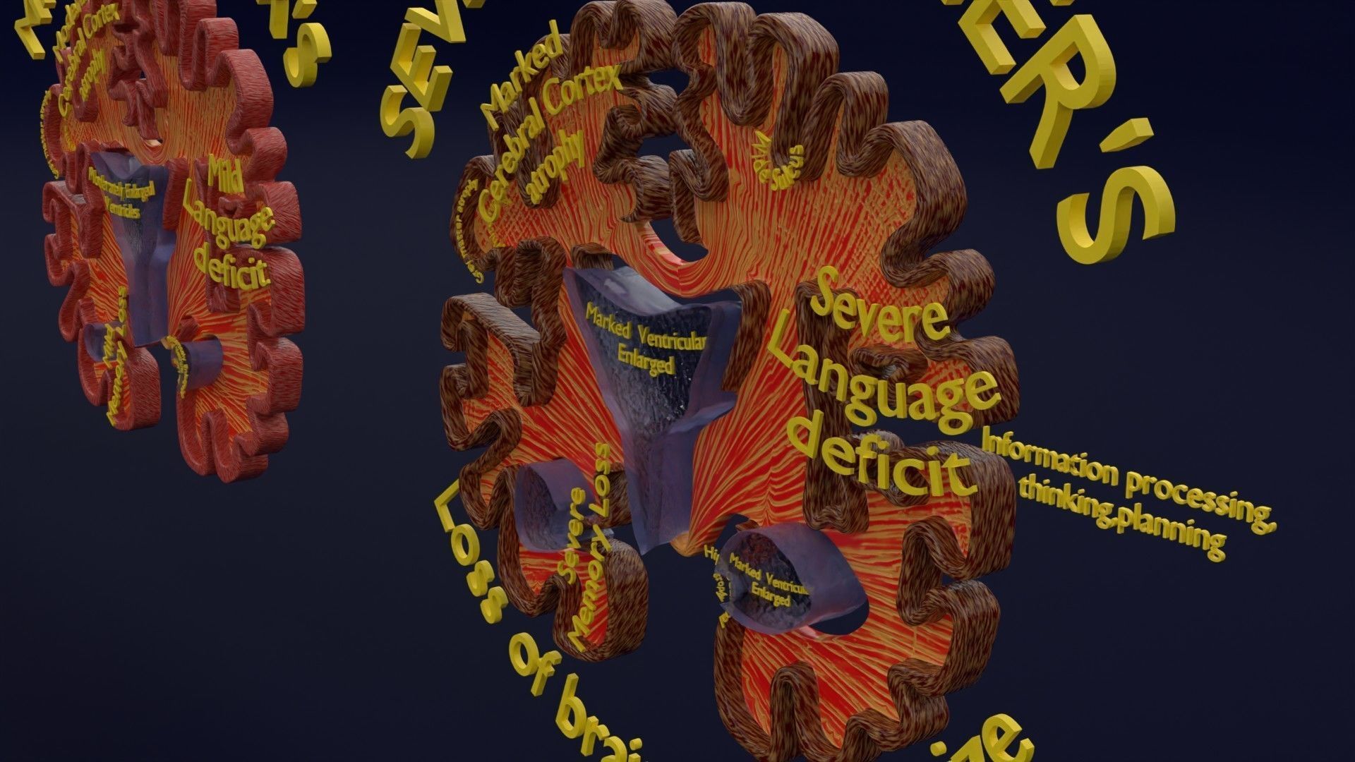Alzheimer Disease Brain coronal slice 3D model_17