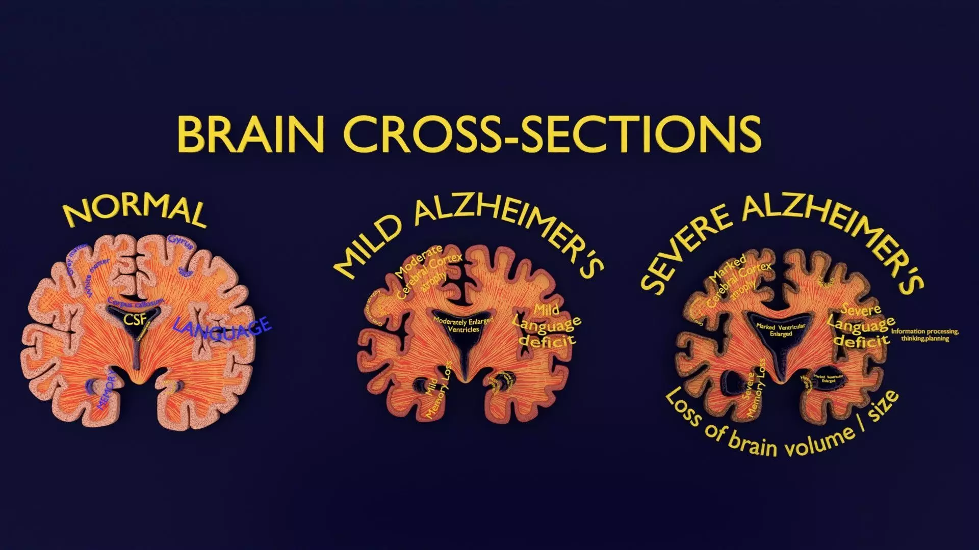 Alzheimer Disease Brain coronal slice 3D model_0