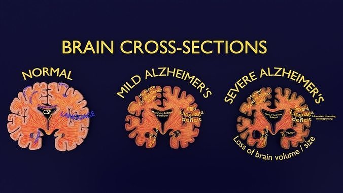 Alzheimer Disease Brain coronal slice 3D model